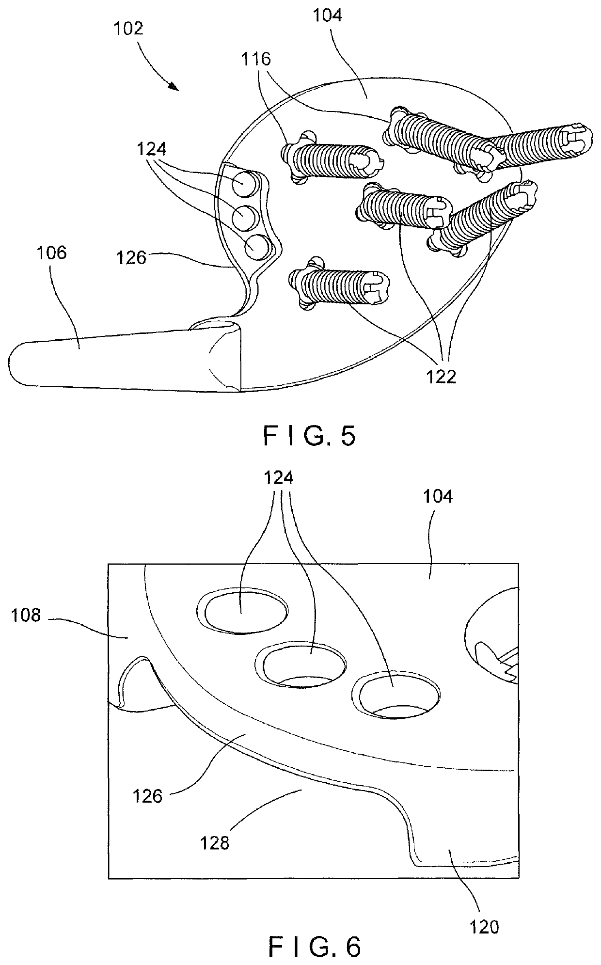 Acromioclavicular hook plate