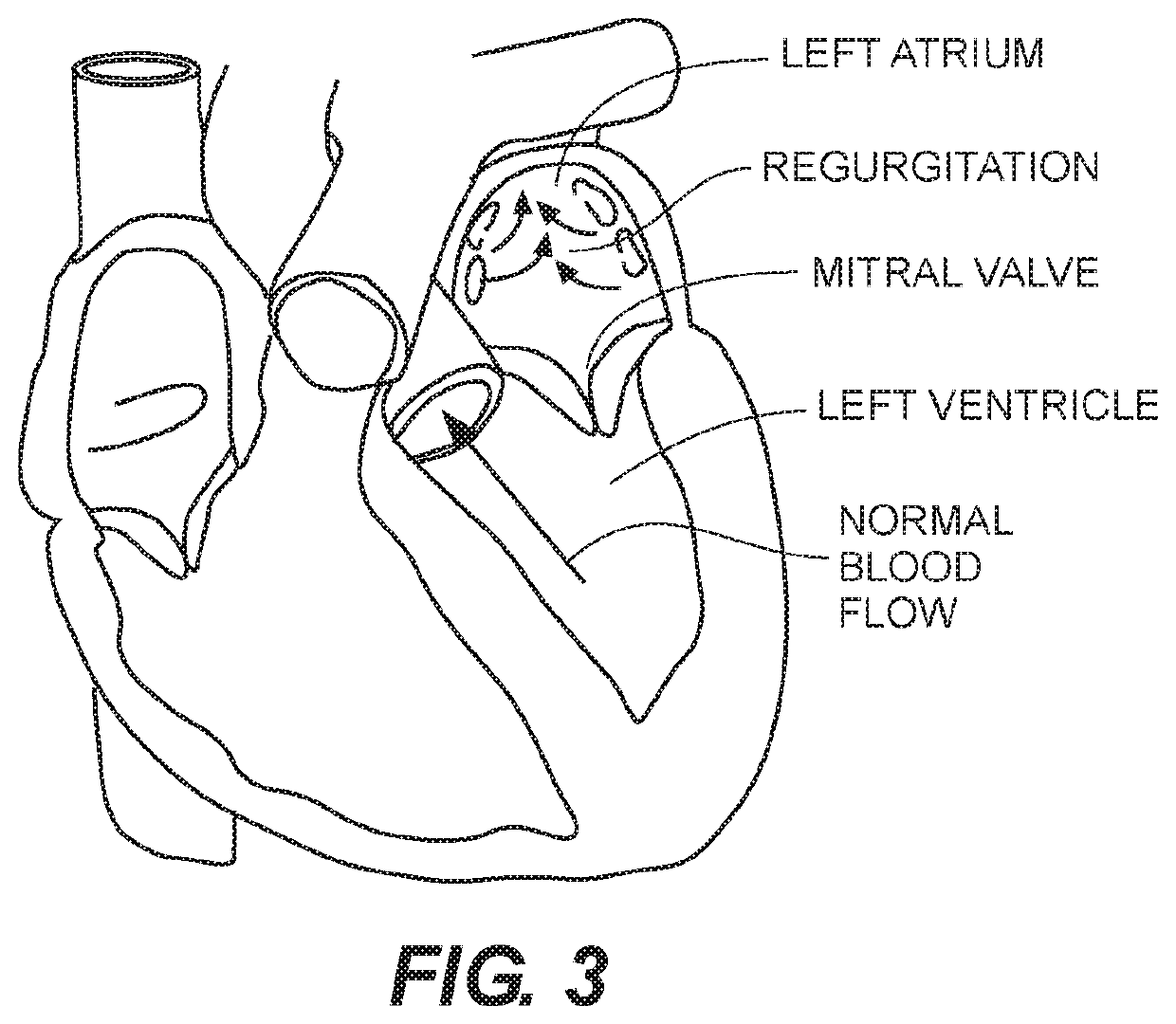 Expandable frames and paravalvular leak mitigation systems for implantable prosthetic heart valve devices