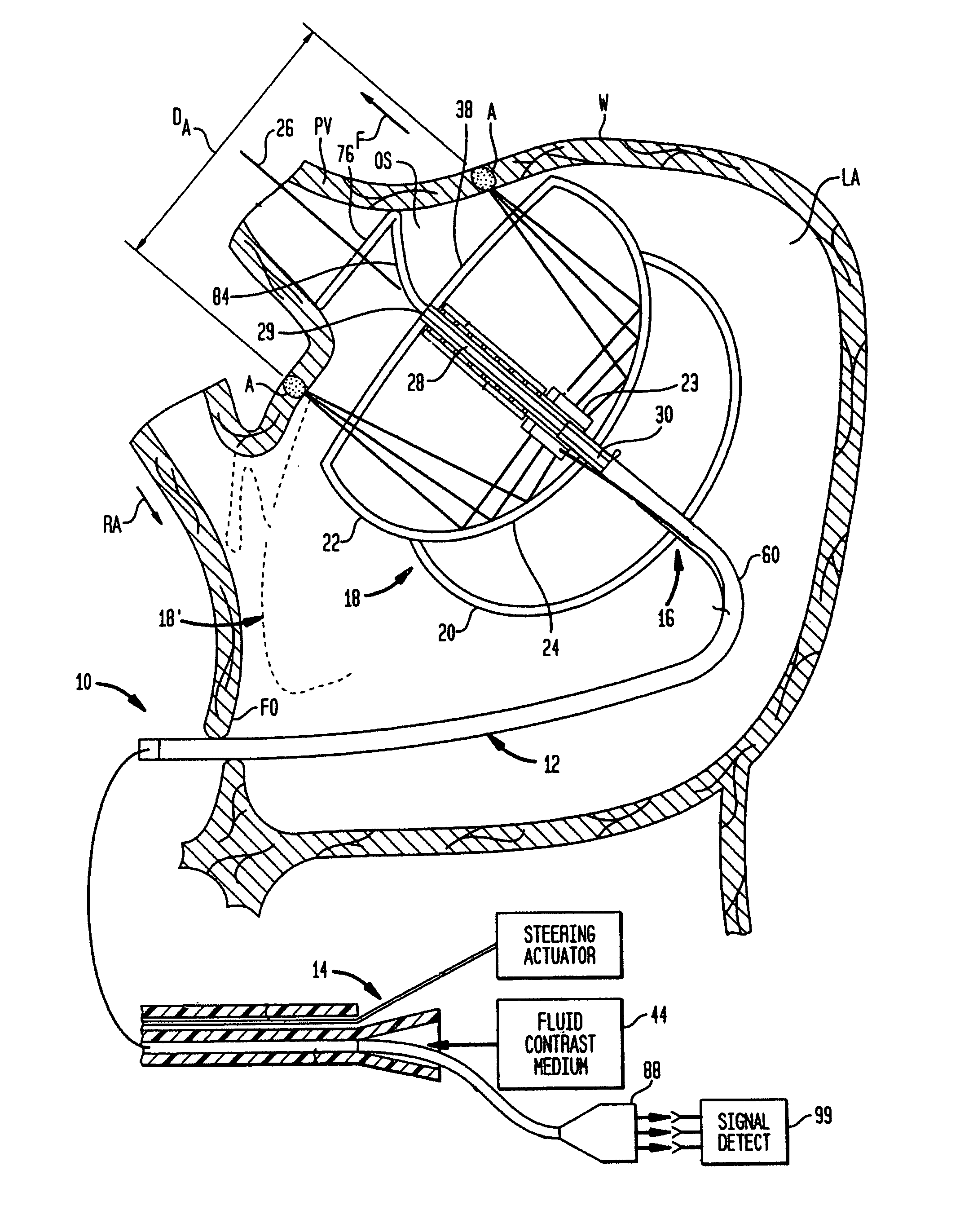 Miniature circular mapping catheter