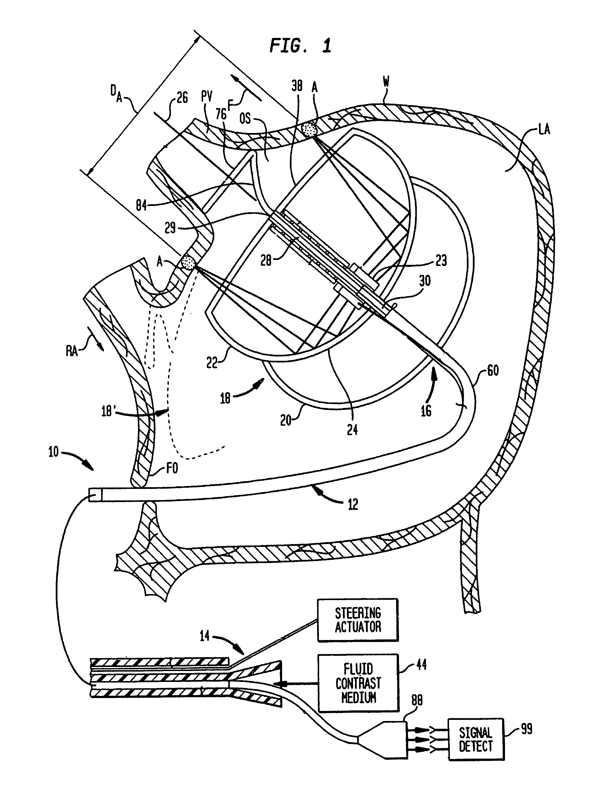 Miniature circular mapping catheter