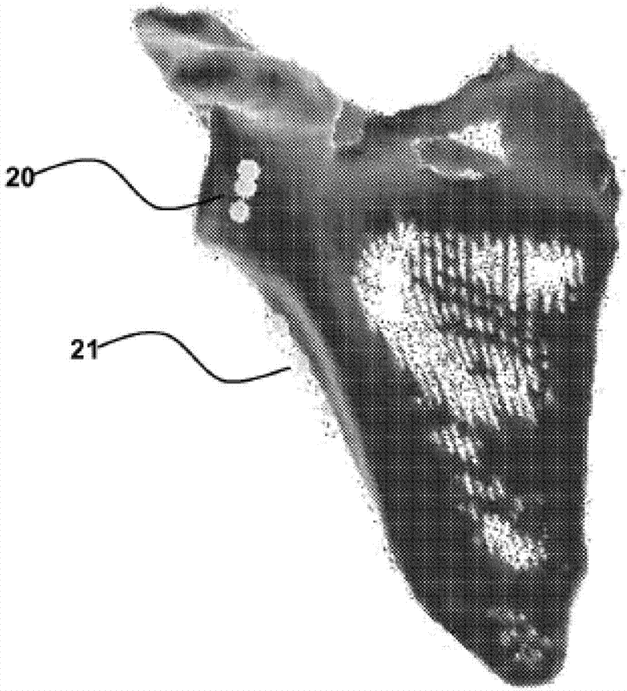 Shoulder replacement apparatus