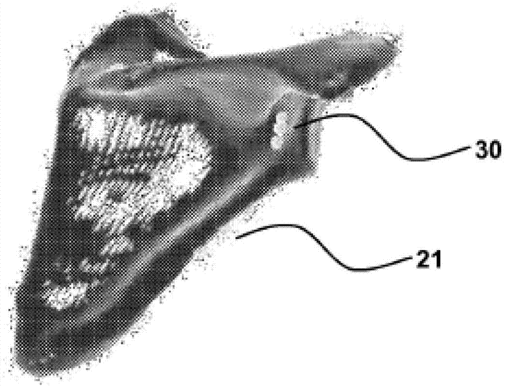 Shoulder replacement apparatus