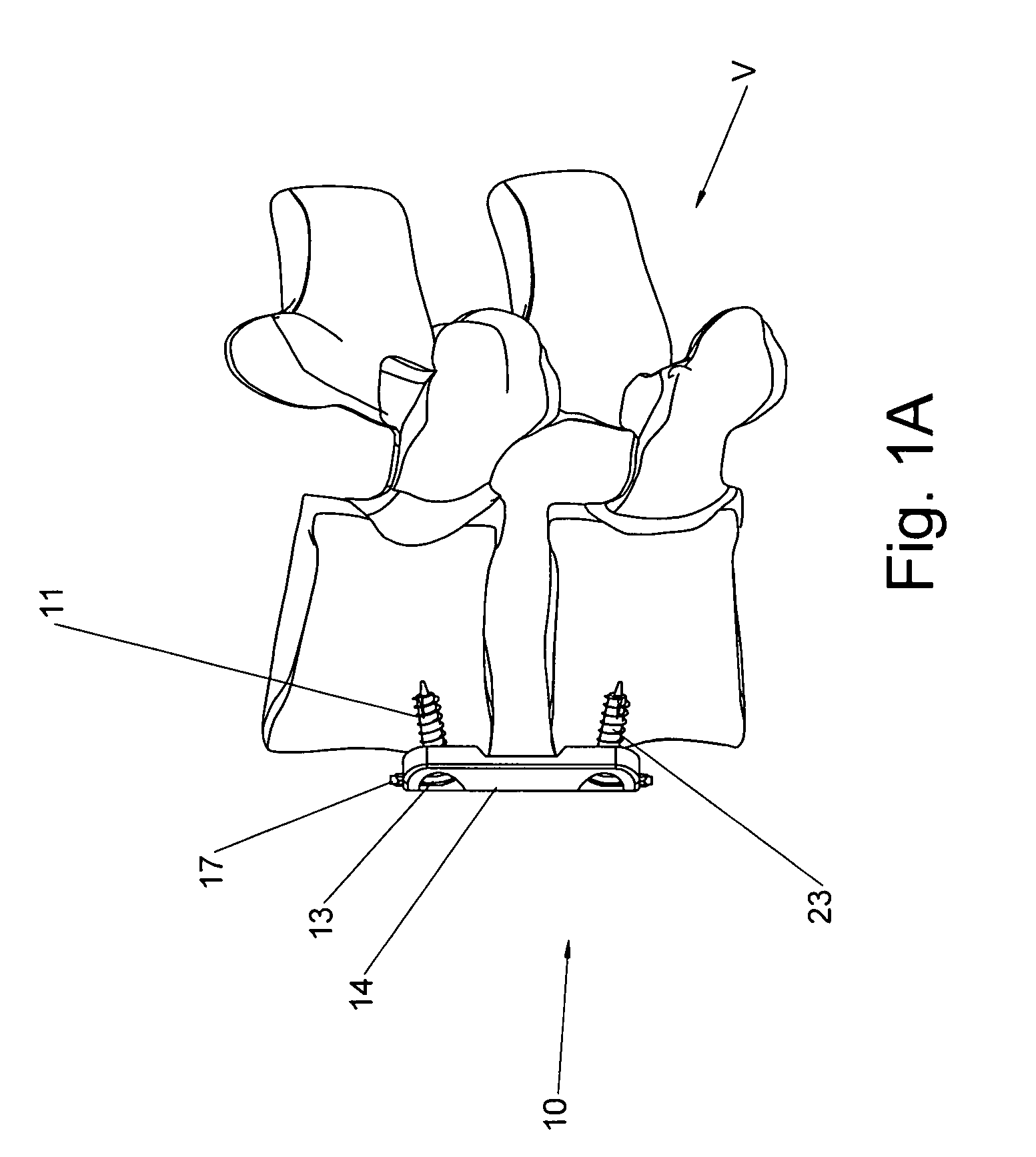 Static anterior cervical plate