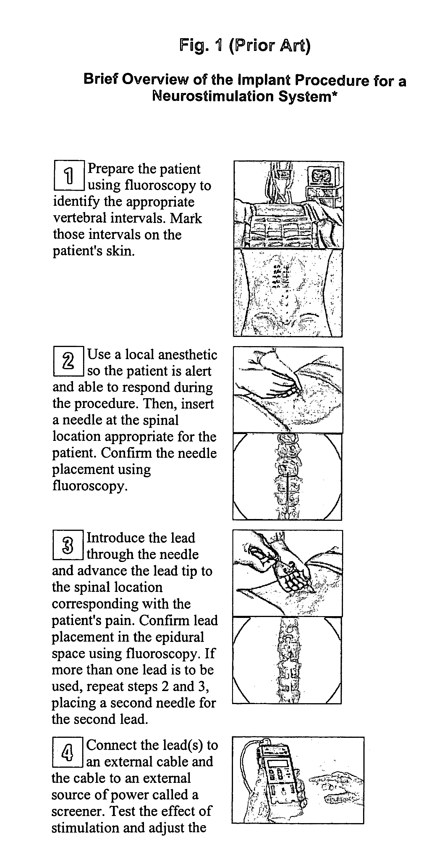 Tunneling needle design having an on-demand removable hub