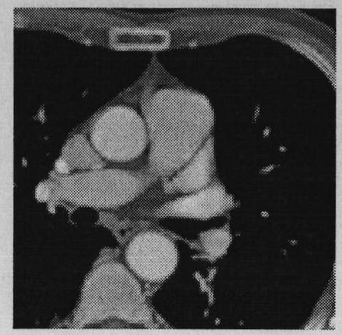 Non-rigid medical image registration method based on finite element model