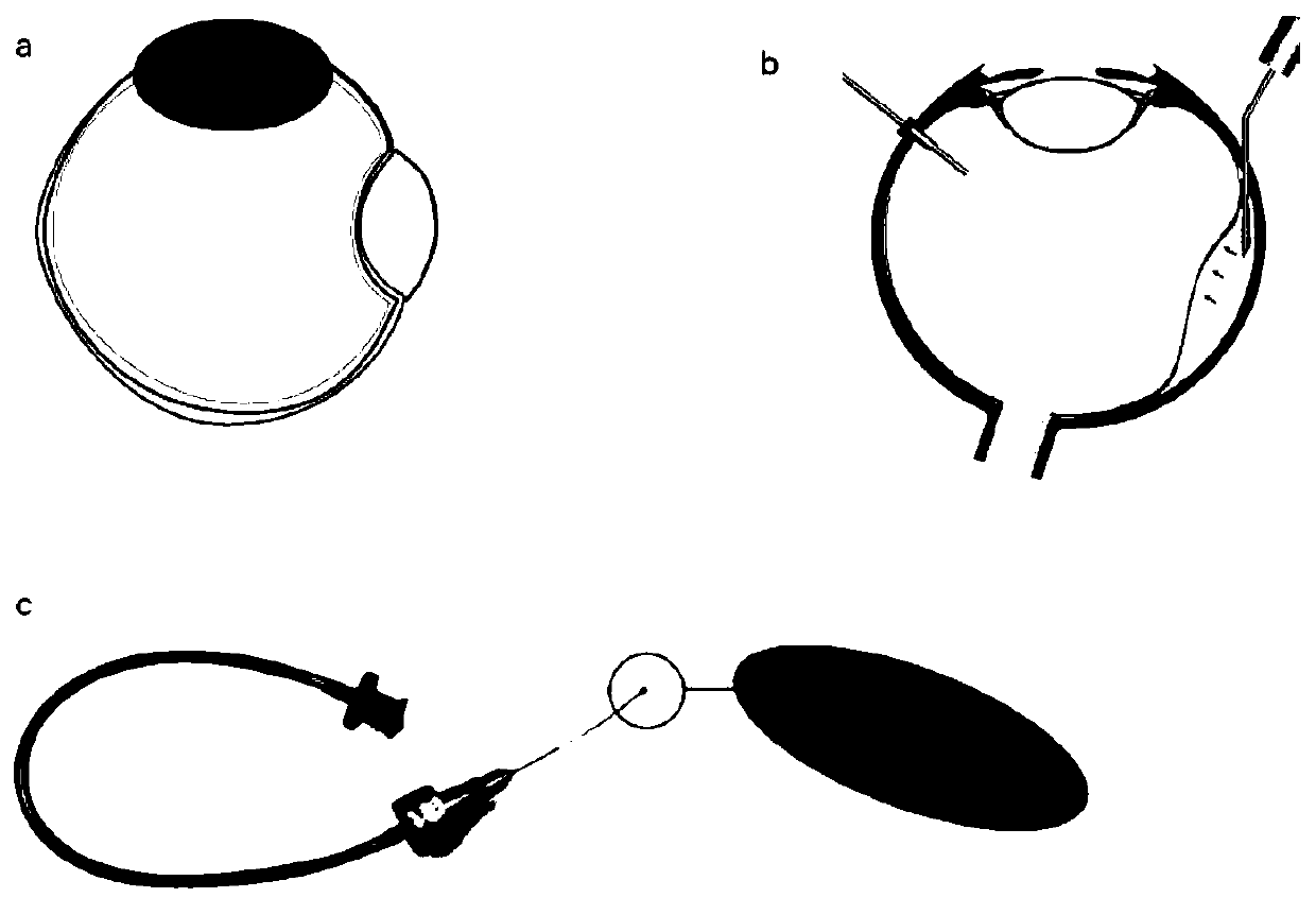 Suprachoroidal pressurizing hydrogel balloon device for rhegmatogenous retinal detachment