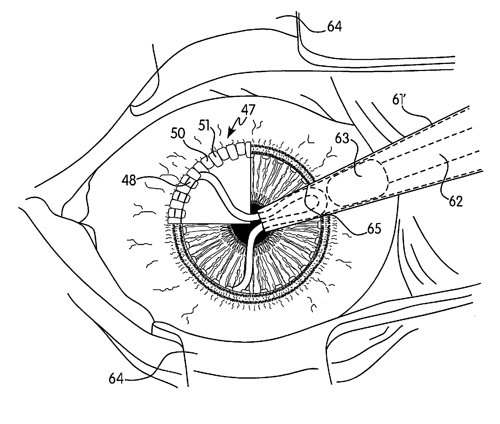 Method of Reducing the Occurrence of Macular and Neuroretinal Degenerations by Alleviating Age Related Retinal Stresses as a Contributing Factor in a Mammalian Eye