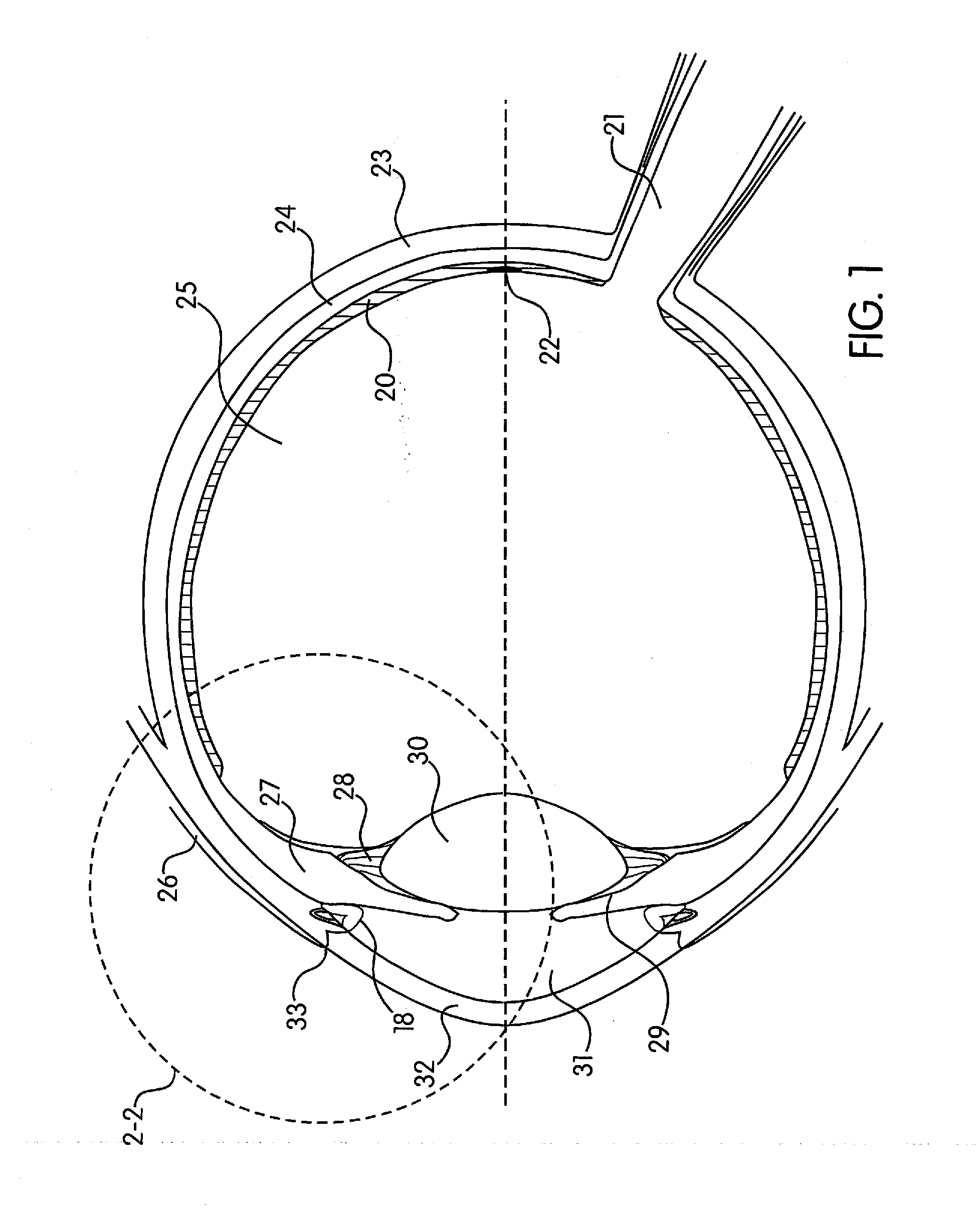 Method of Reducing the Occurrence of Macular and Neuroretinal Degenerations by Alleviating Age Related Retinal Stresses as a Contributing Factor in a Mammalian Eye