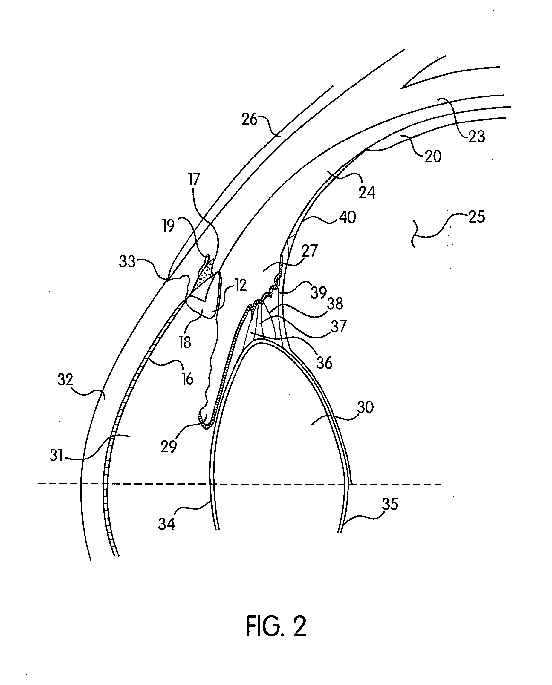 Method of Reducing the Occurrence of Macular and Neuroretinal Degenerations by Alleviating Age Related Retinal Stresses as a Contributing Factor in a Mammalian Eye