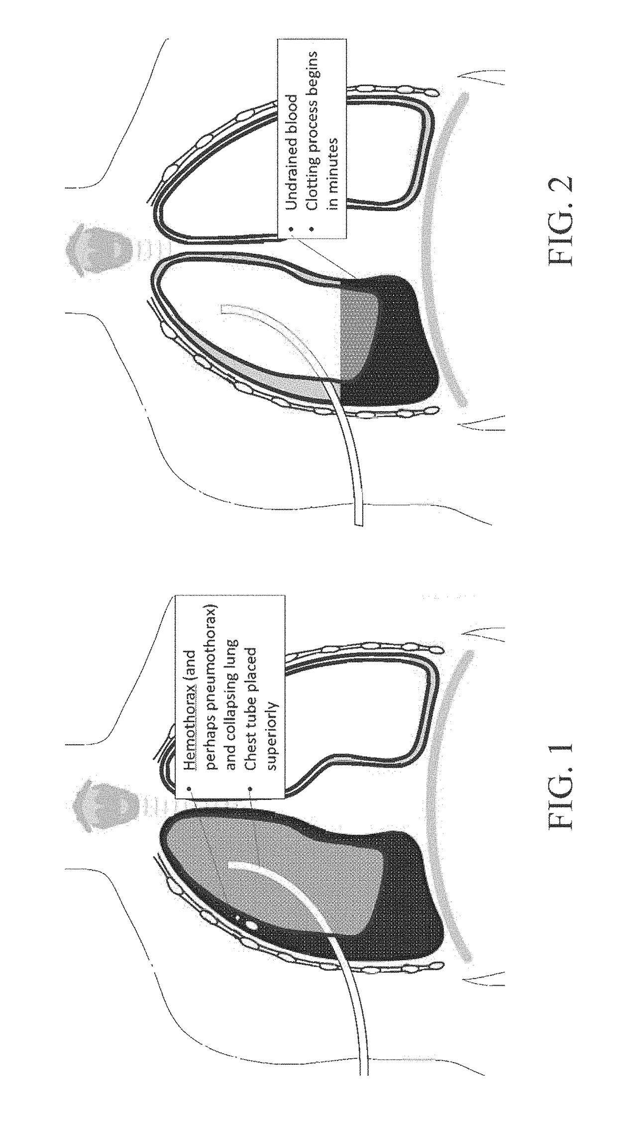 System for improving fluid drainage