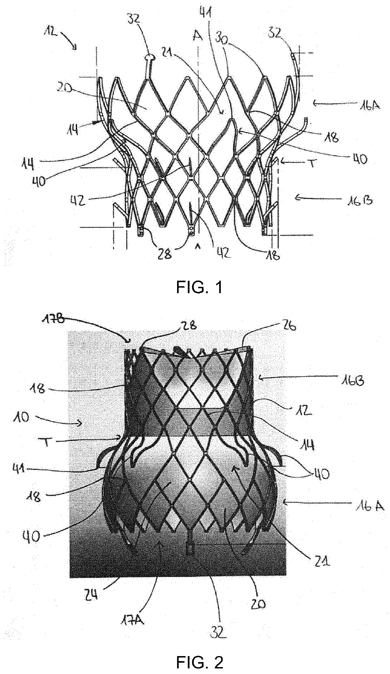 Mitral Stent