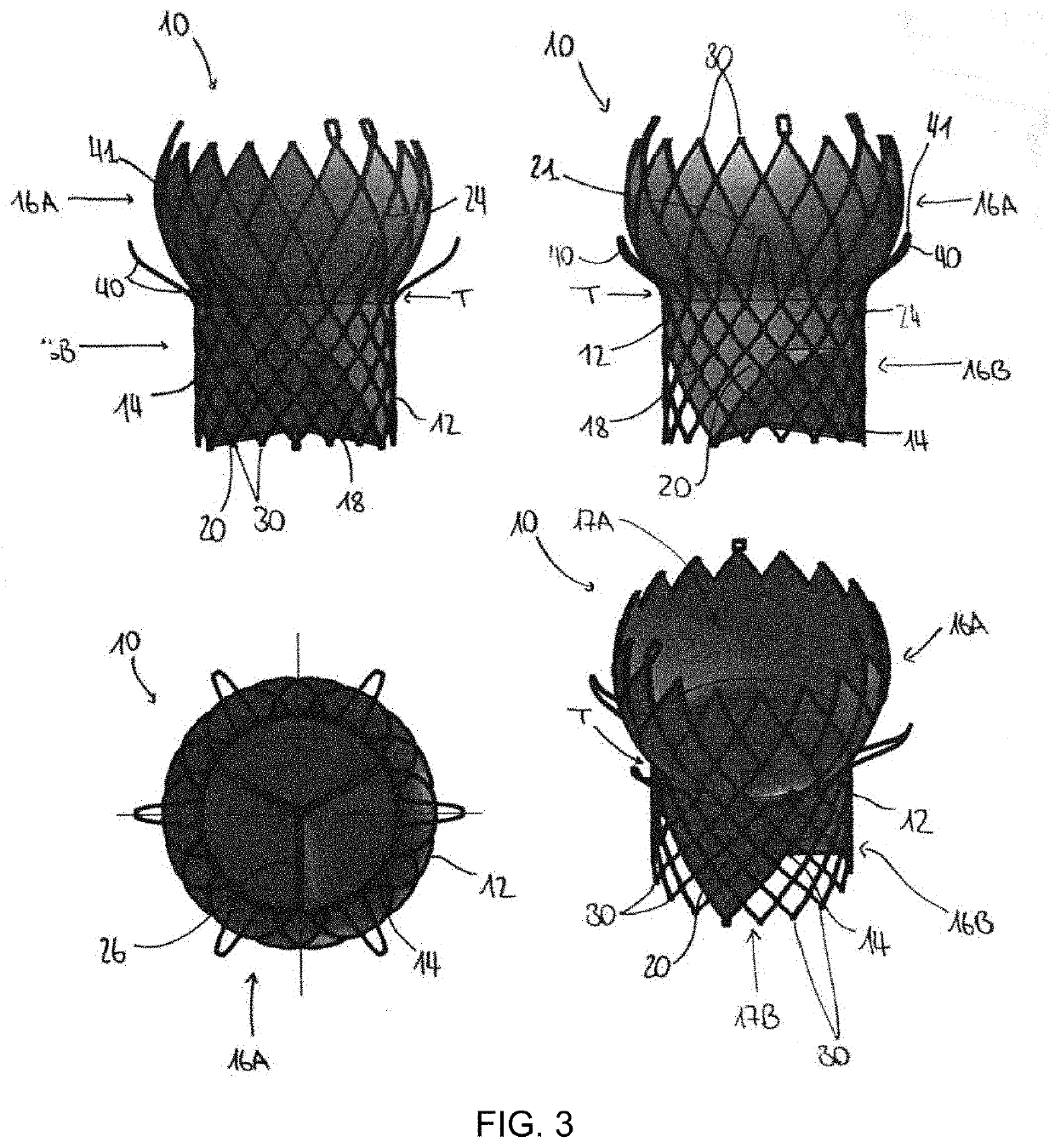 Mitral Stent