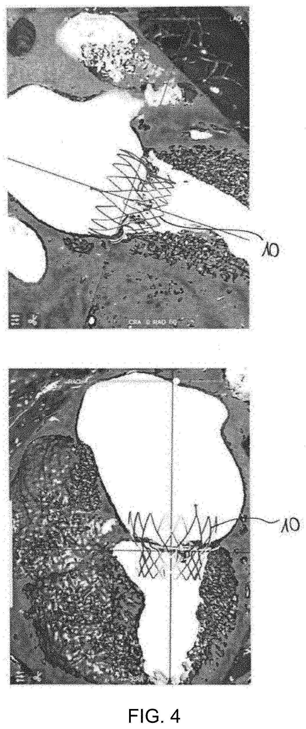 Mitral Stent