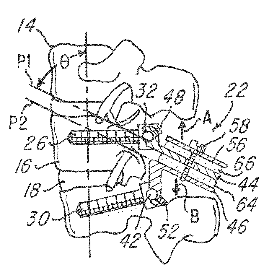 Disk augmentation system and method