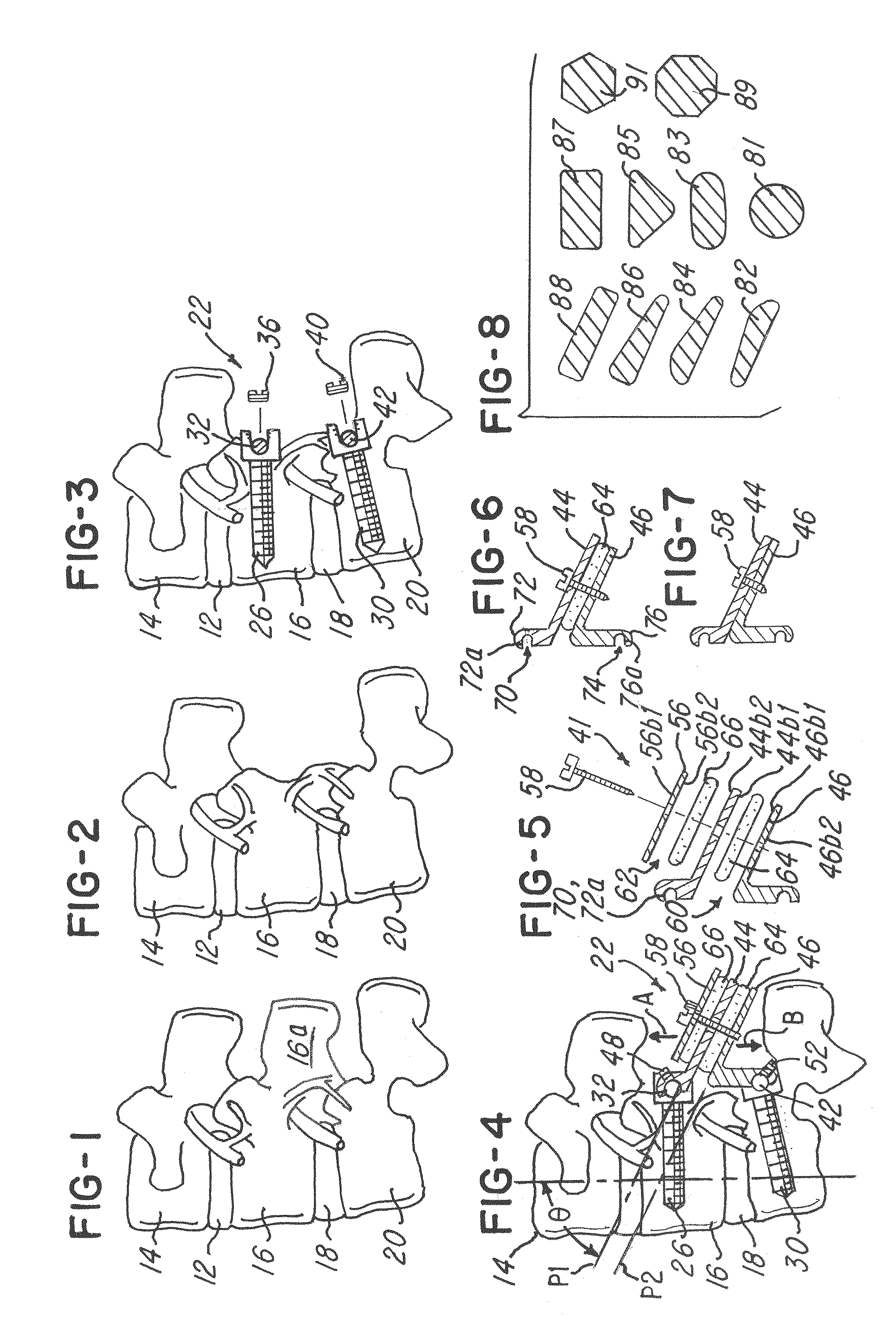 Disk augmentation system and method