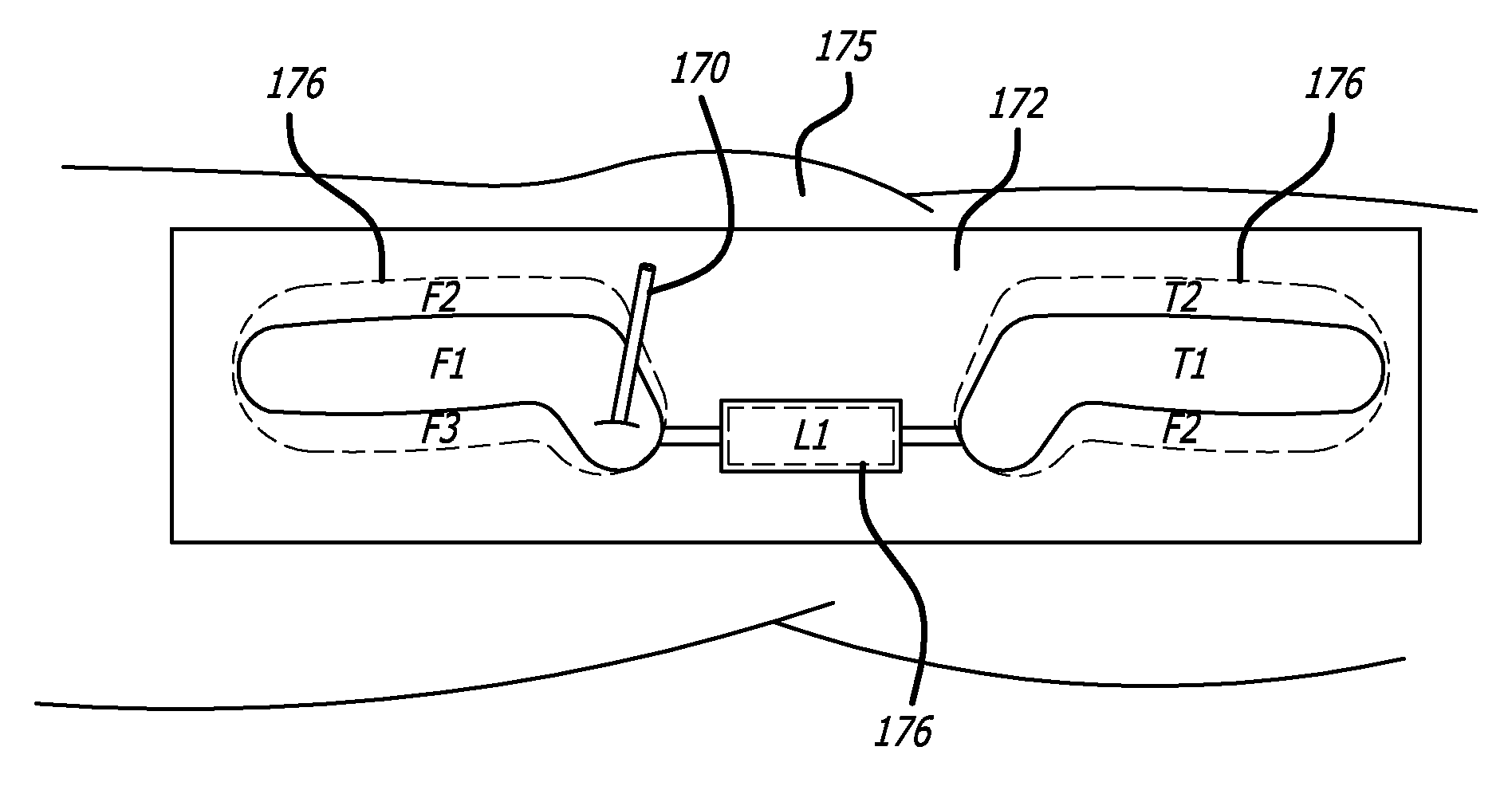 Surgical implantation method and devices for an extra-articular mechanical energy absorbing apparatus