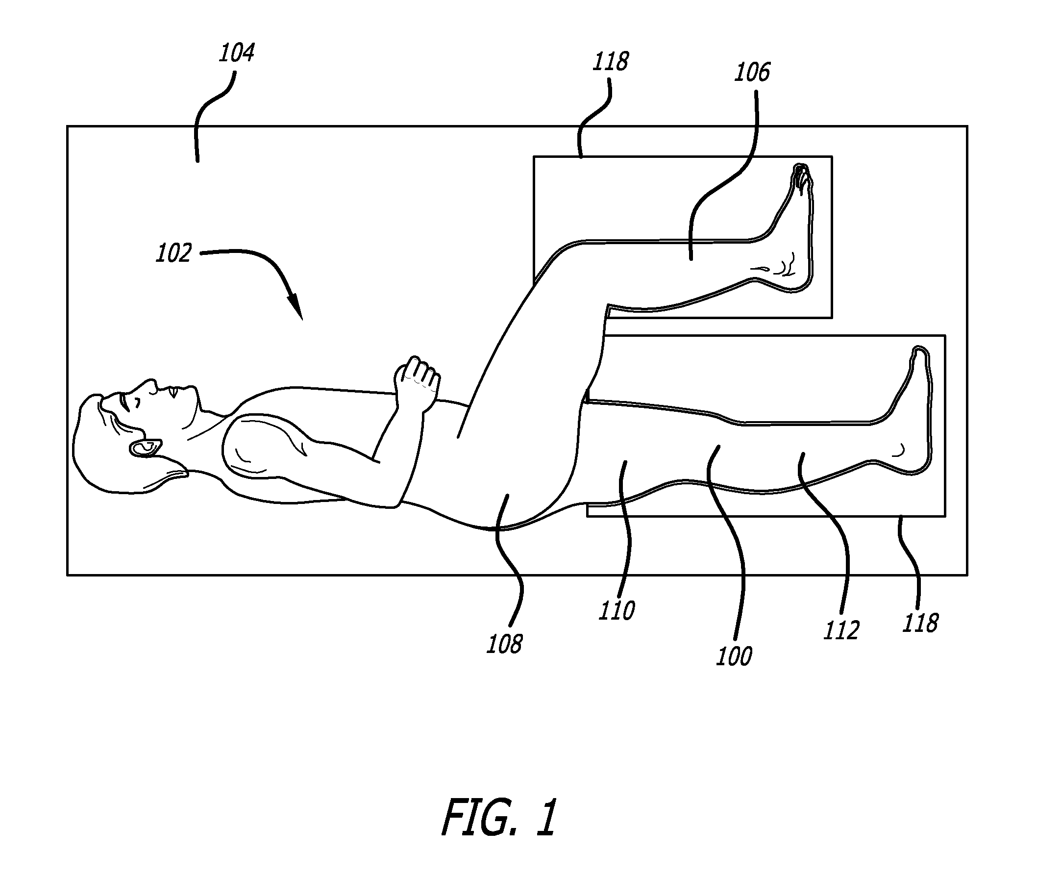 Surgical implantation method and devices for an extra-articular mechanical energy absorbing apparatus