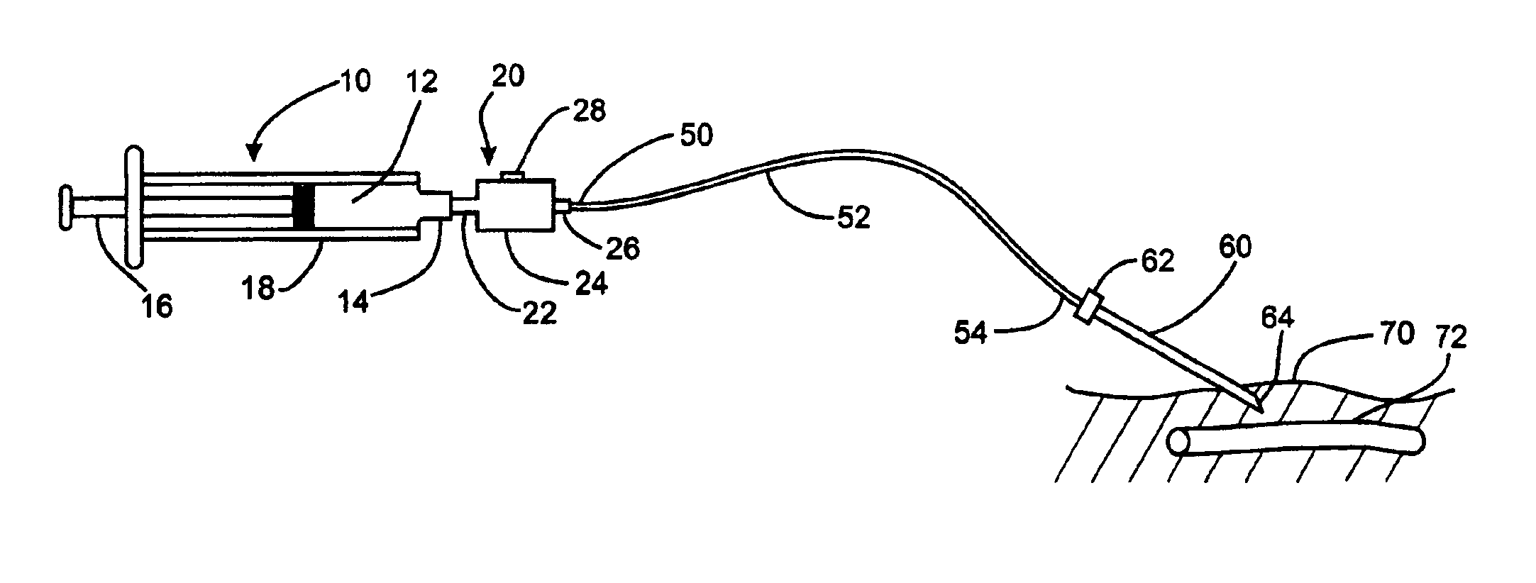 Method and apparatus to decrease the risk of intraneuronal injection during administration of nerve block anesthesia