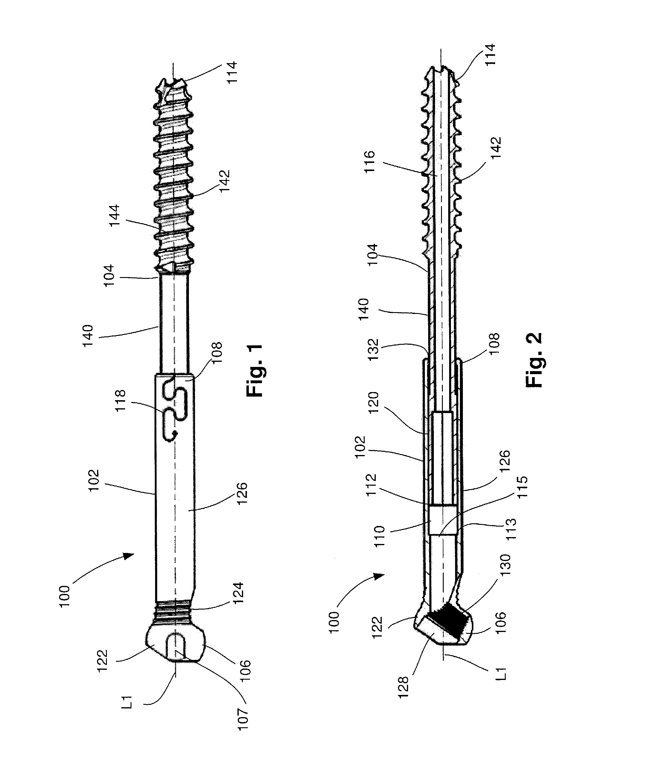 Telescoping screw for femoral neck fractures