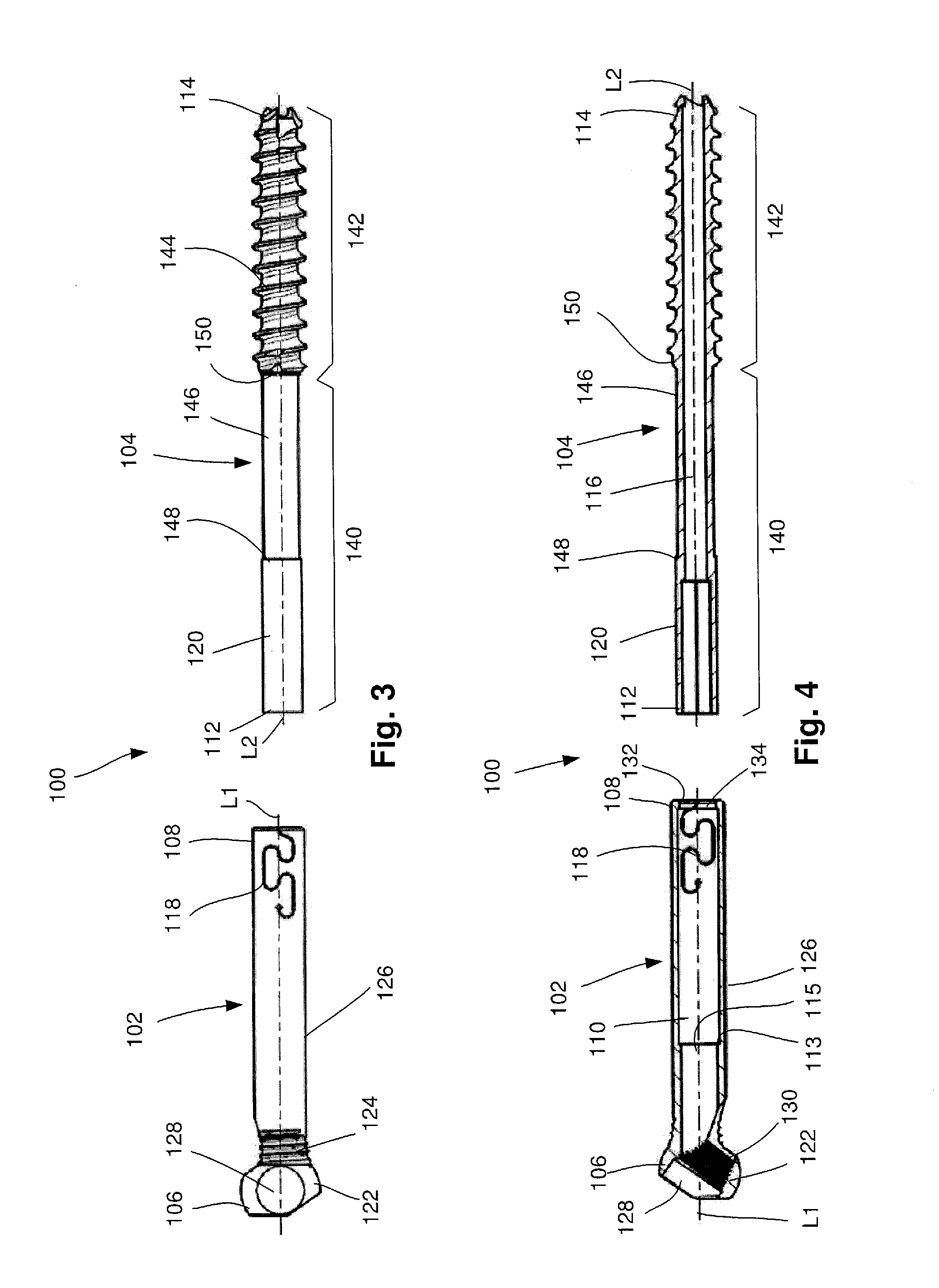 Telescoping screw for femoral neck fractures