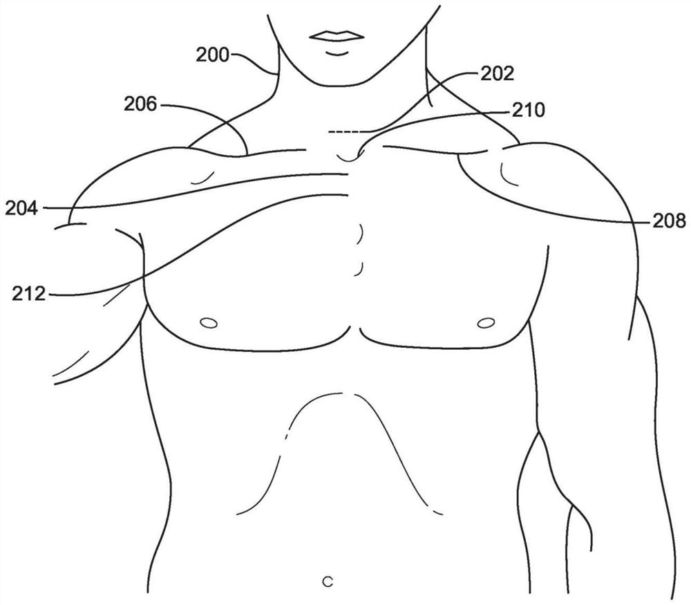 Devices and methods for catheter-based cardiac procedures