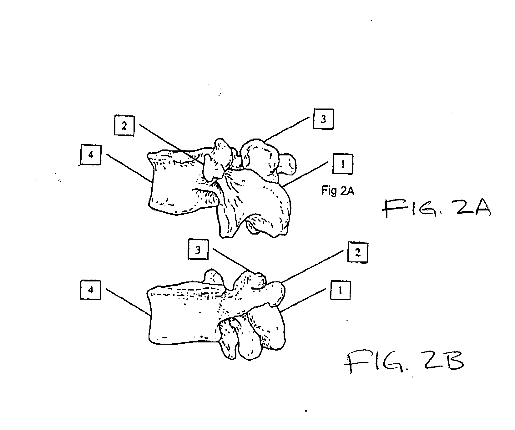 Transosseous spine core approach method implant and instrumentation