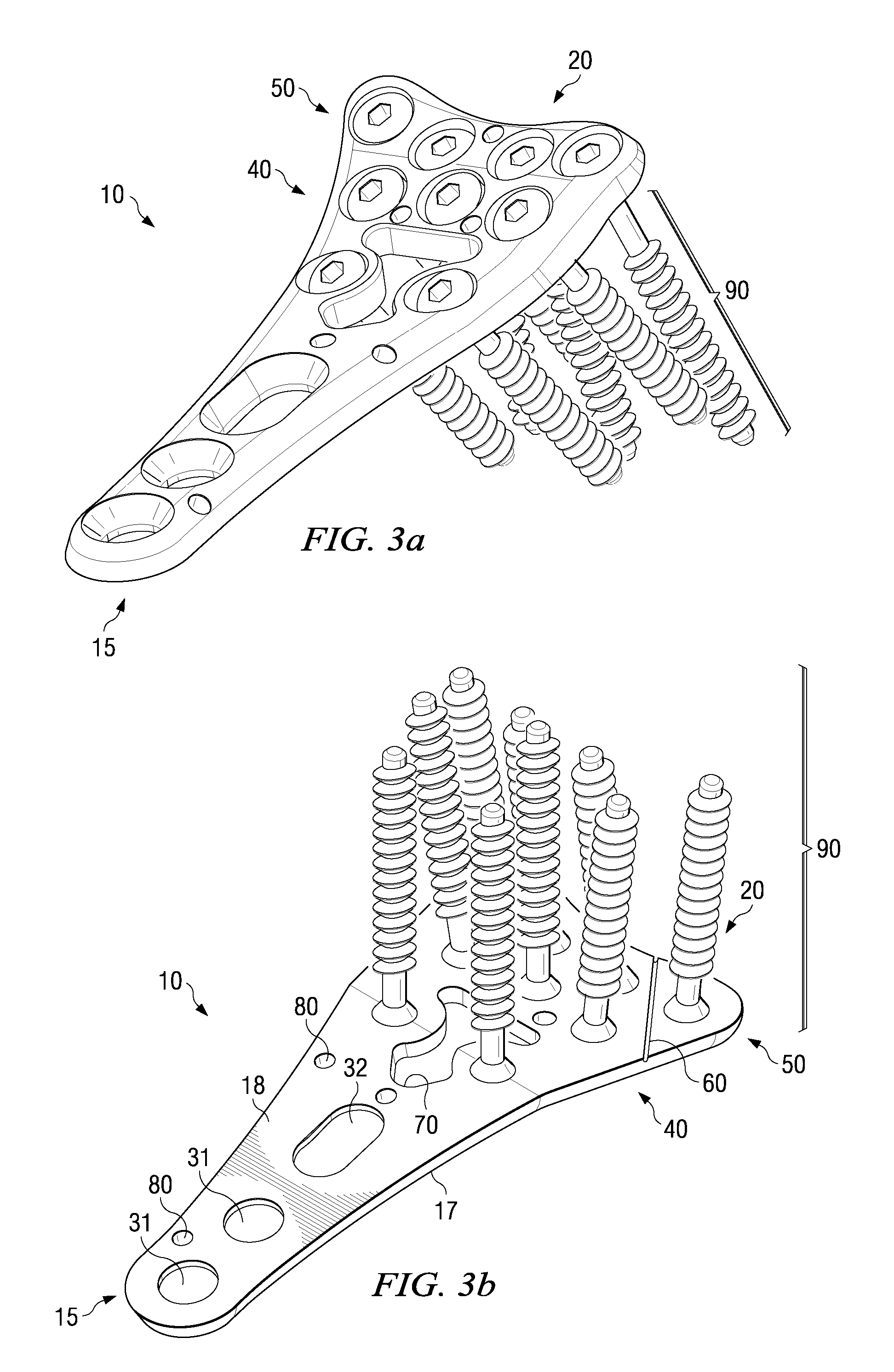 Volar plate fixation device