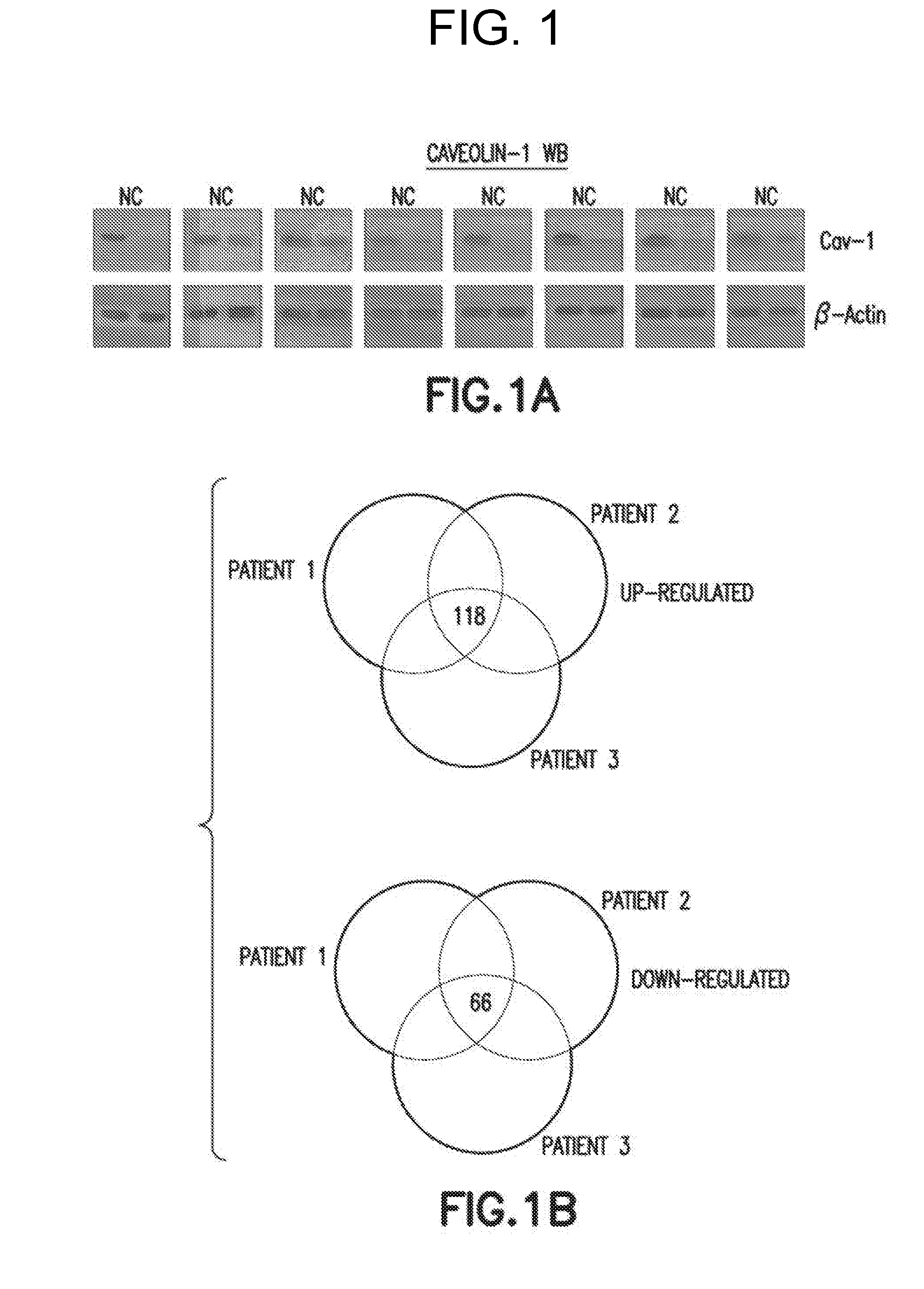 Method of Diagnosis or Prognosis of a Neoplasm Comprising Determining the Level of Expression of a Protein in Stromal Cells Adjacent to the Neoplasm