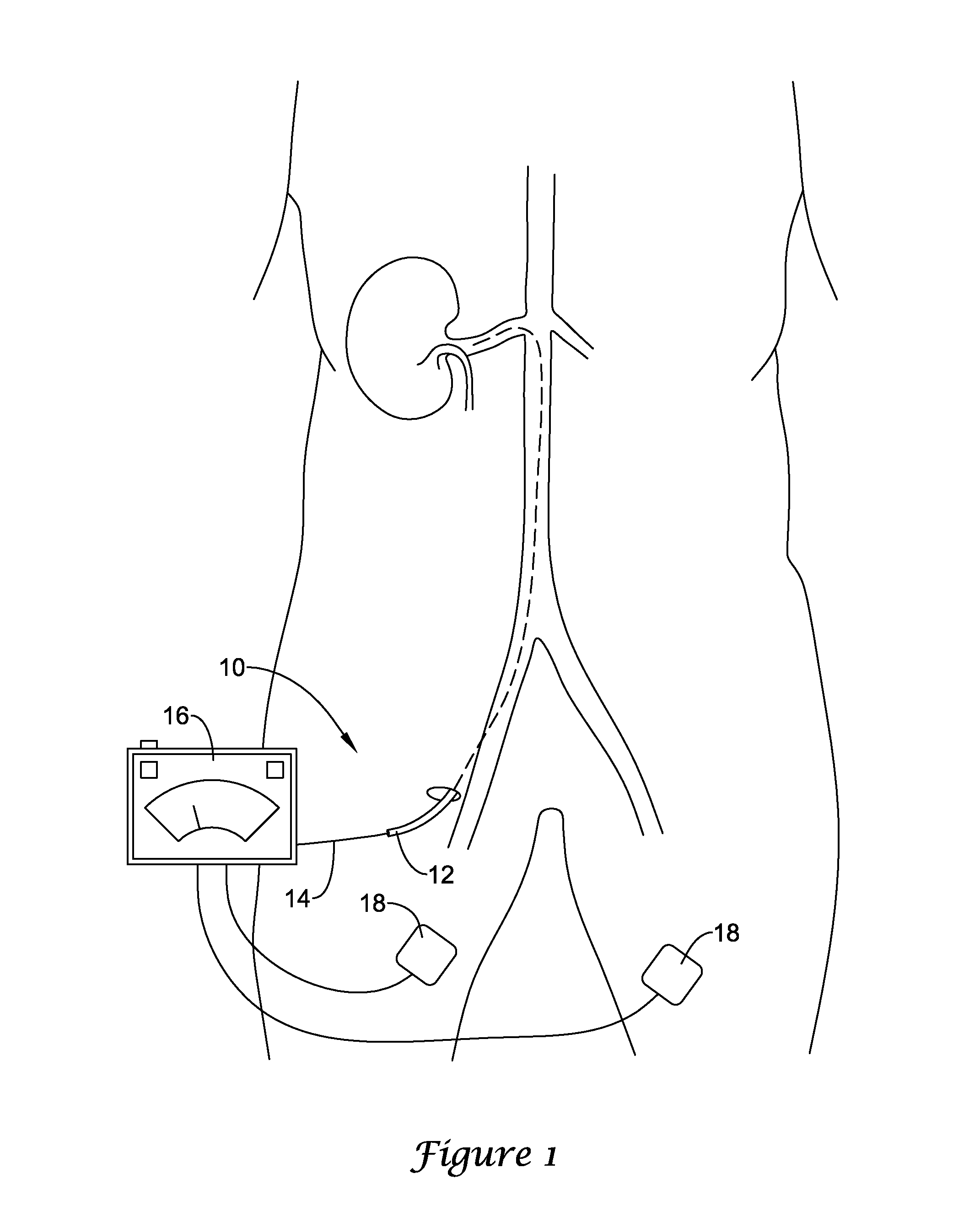 Deflectable medical devices