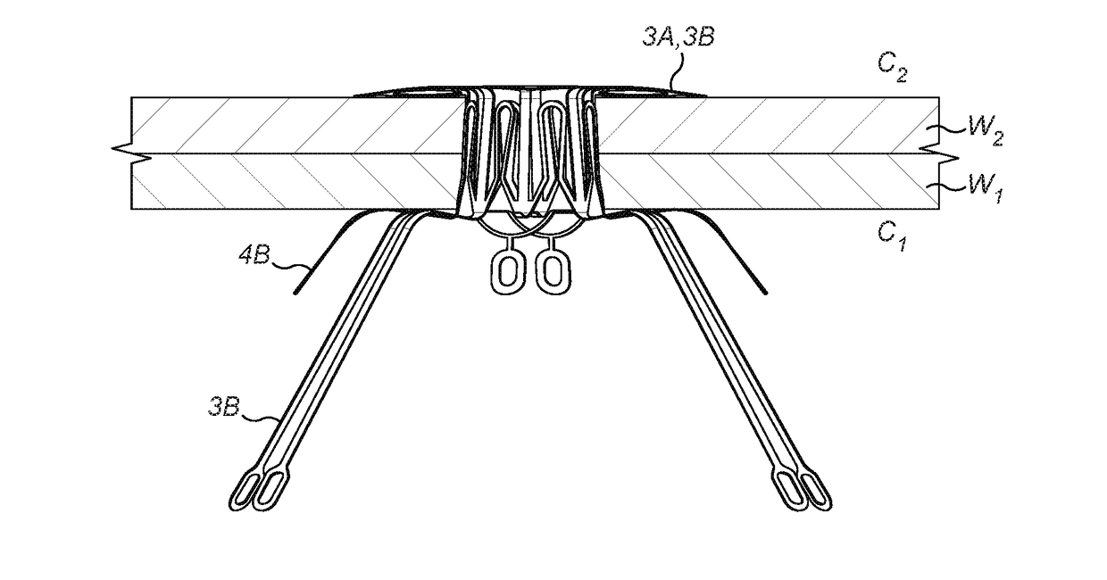 Method for coupling anatomical walls using a connector