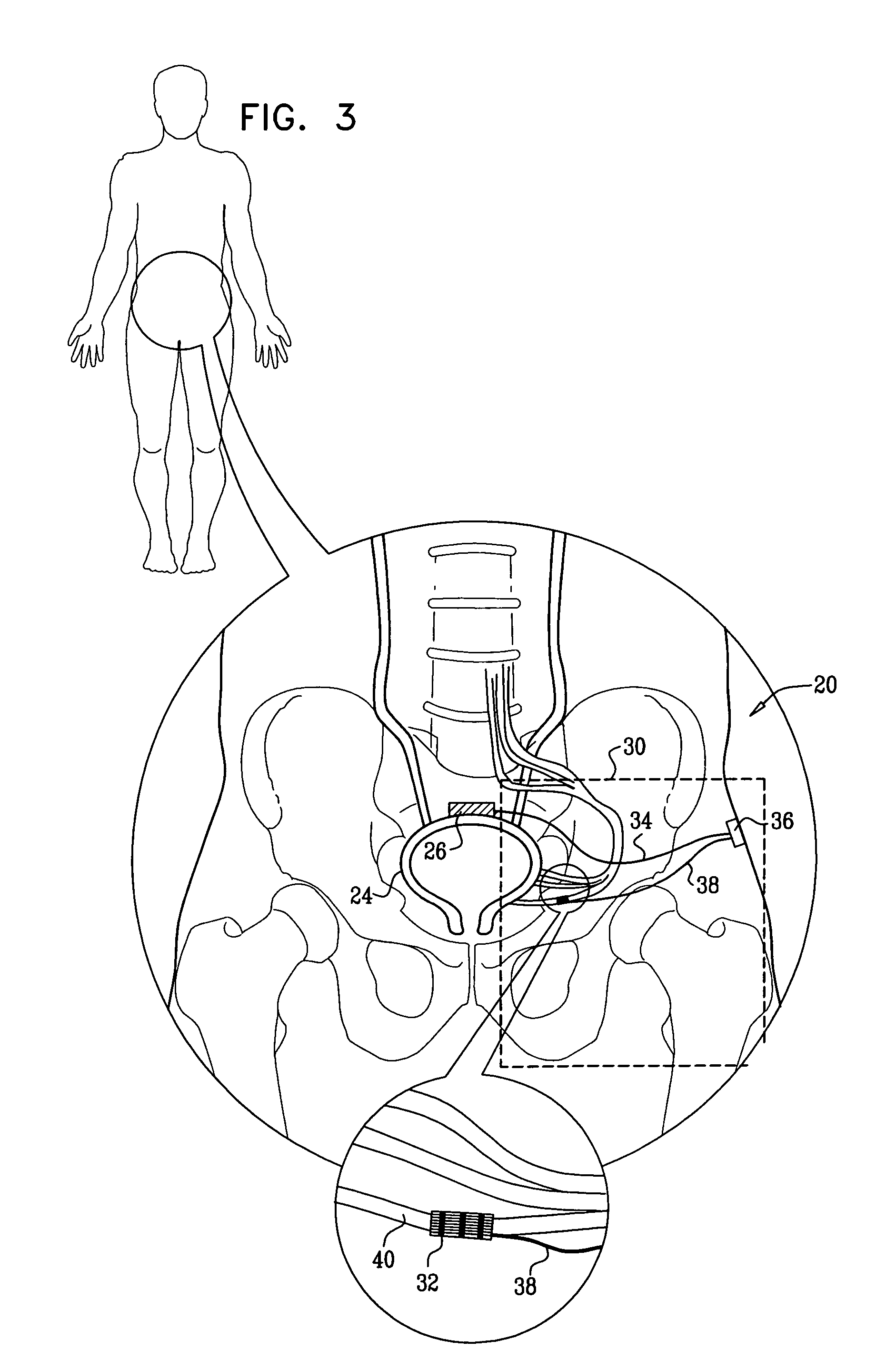 Treatment of bladder dysfunction