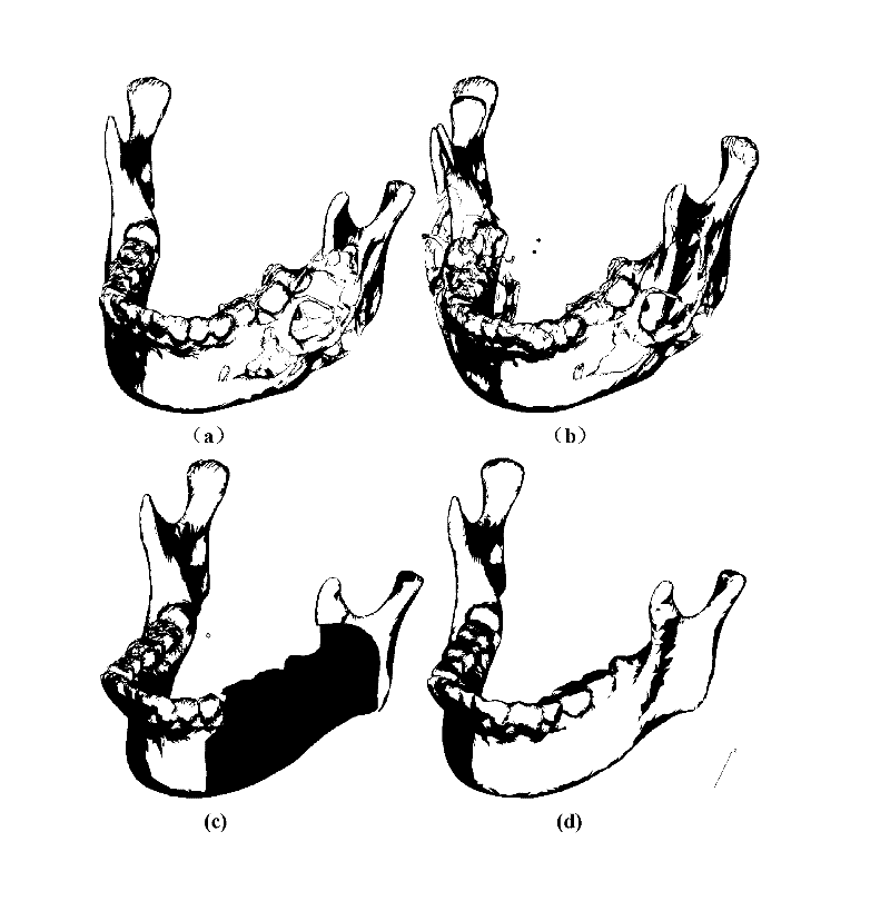 Manufacture method of tissue engineering bracket with both internal microstructure and individualized appearance