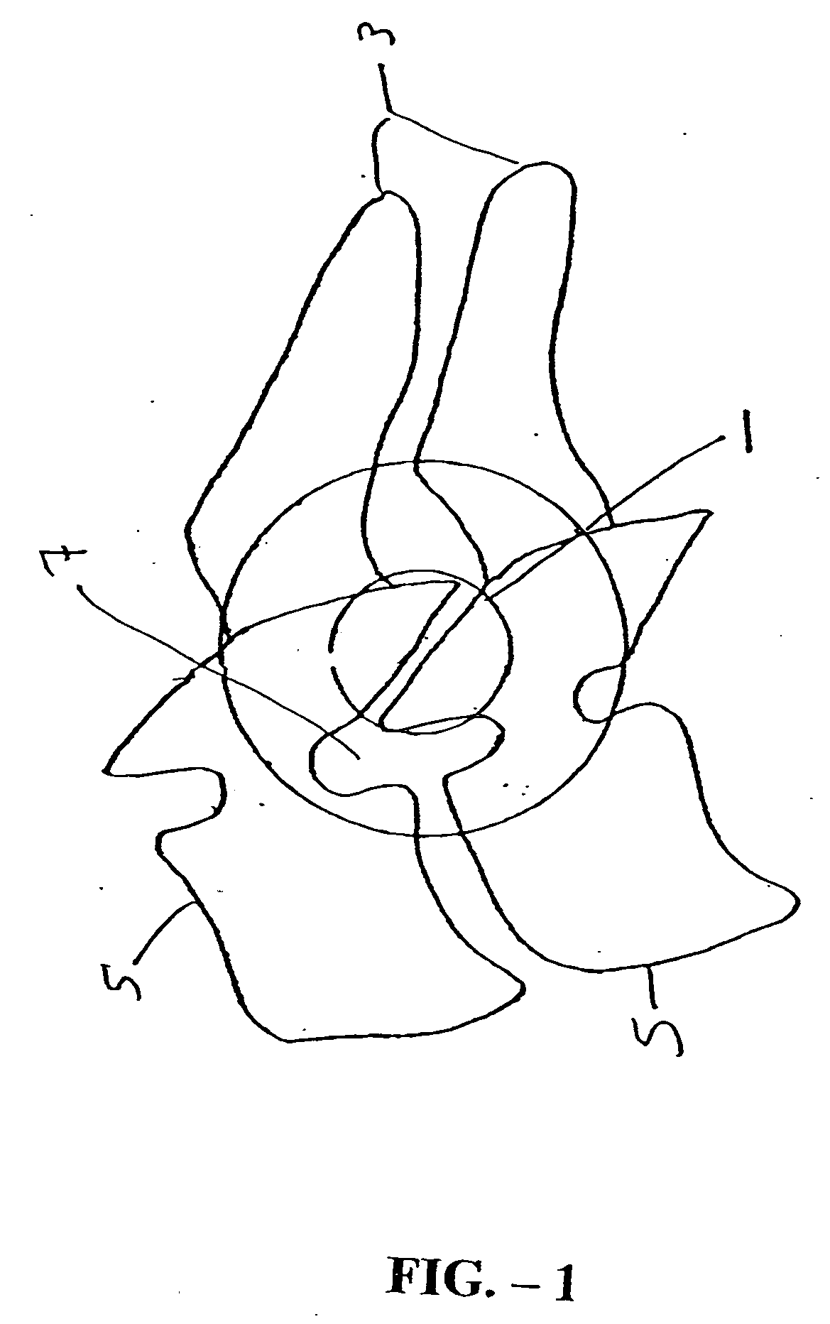 Inter-cervical facet implant and method