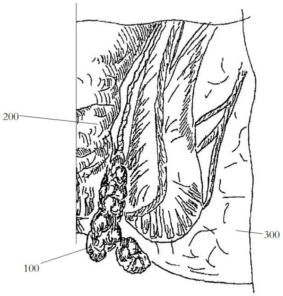 Anorectal stapler for hemorrhoidectomy