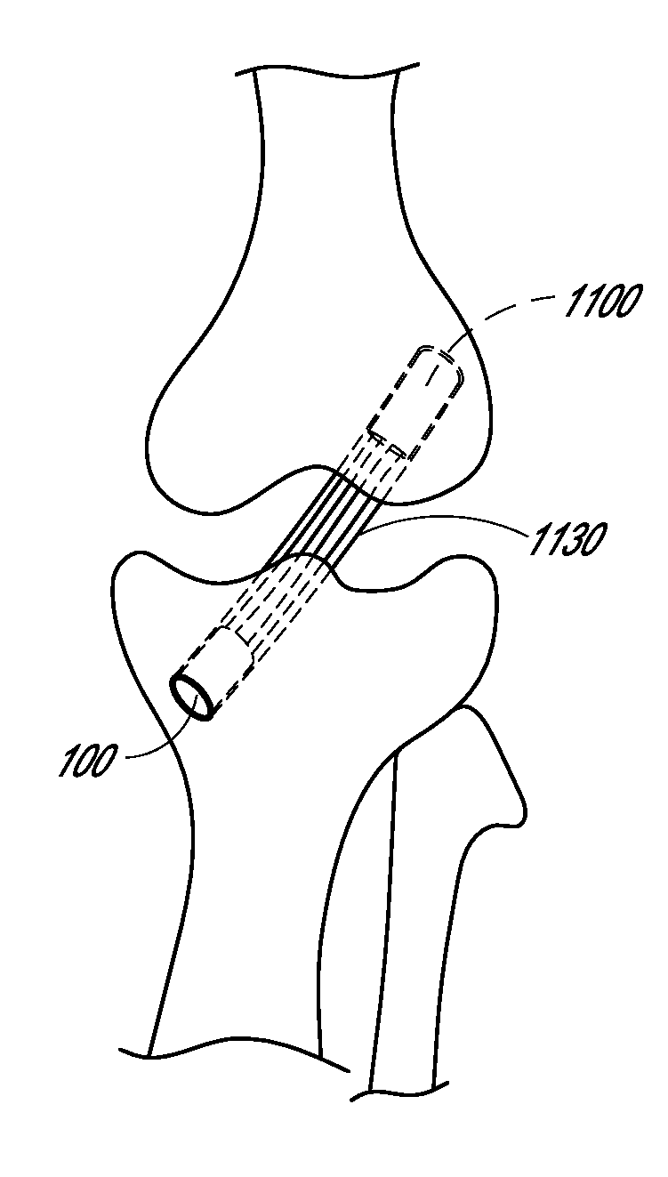 System and method for securing tissue to bone