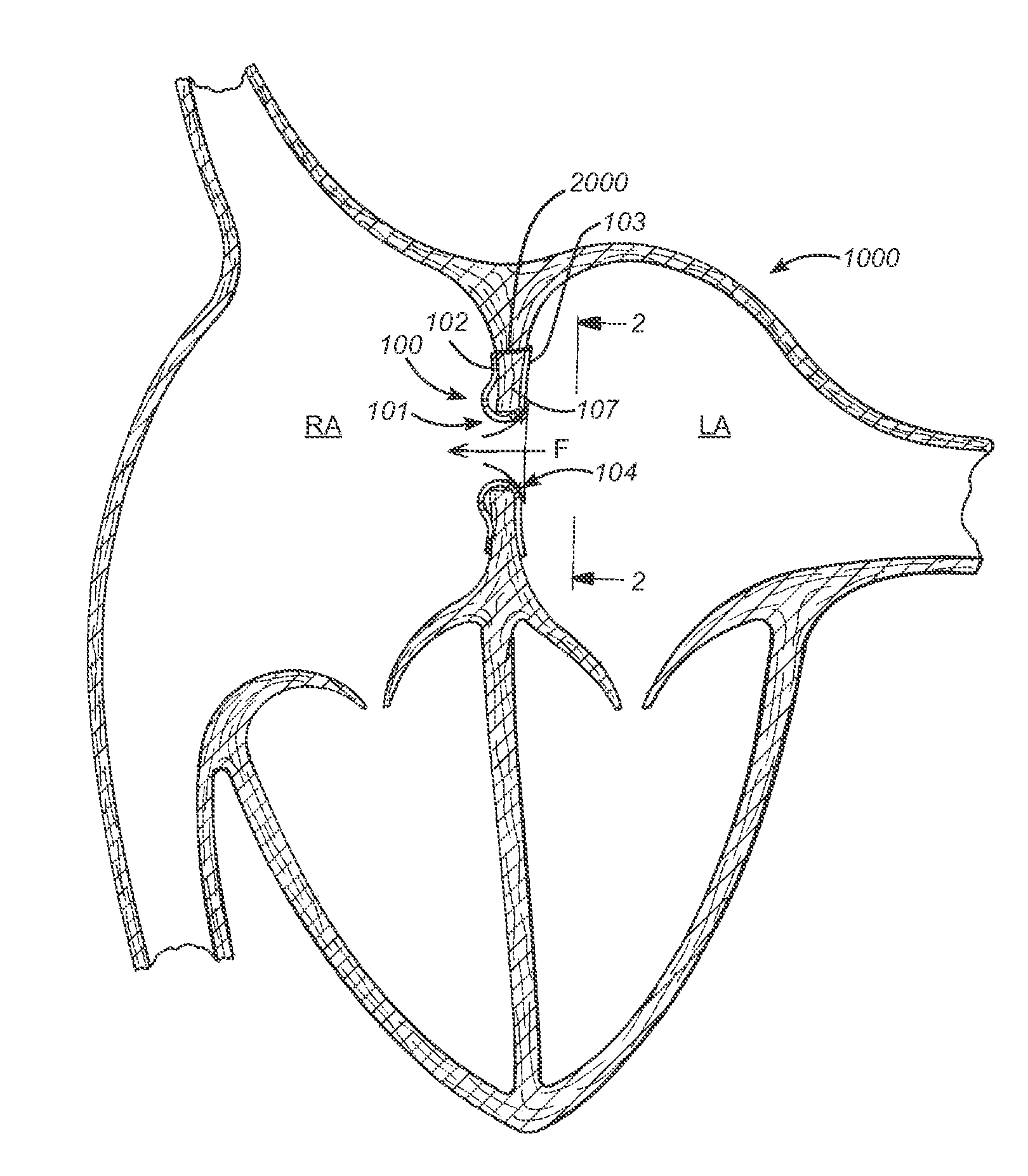 Prosthesis for retrieval and deployment