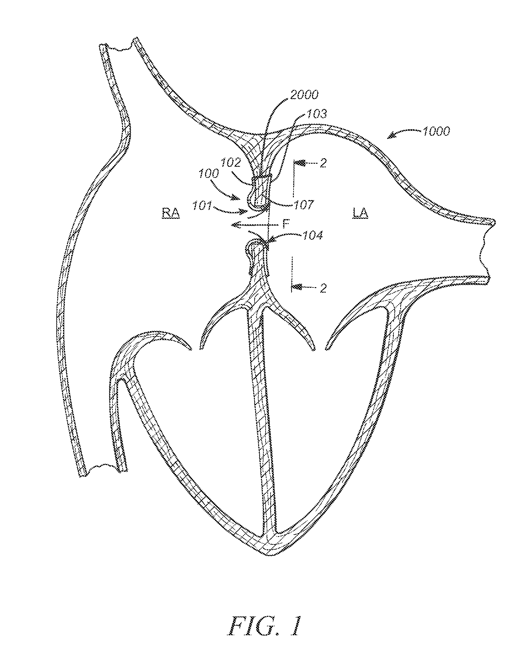 Prosthesis for retrieval and deployment