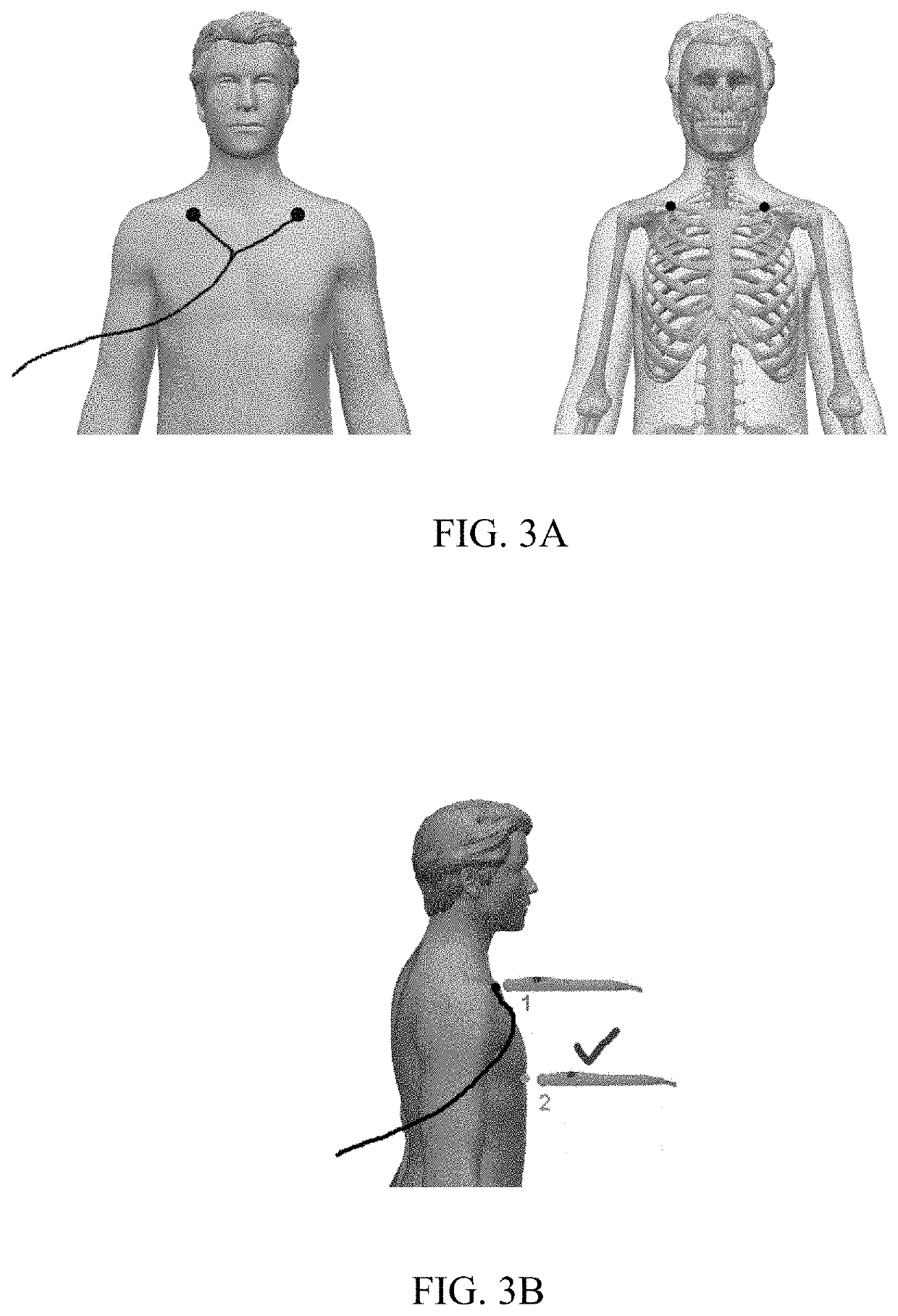 Guidance system with claviculae position sensors