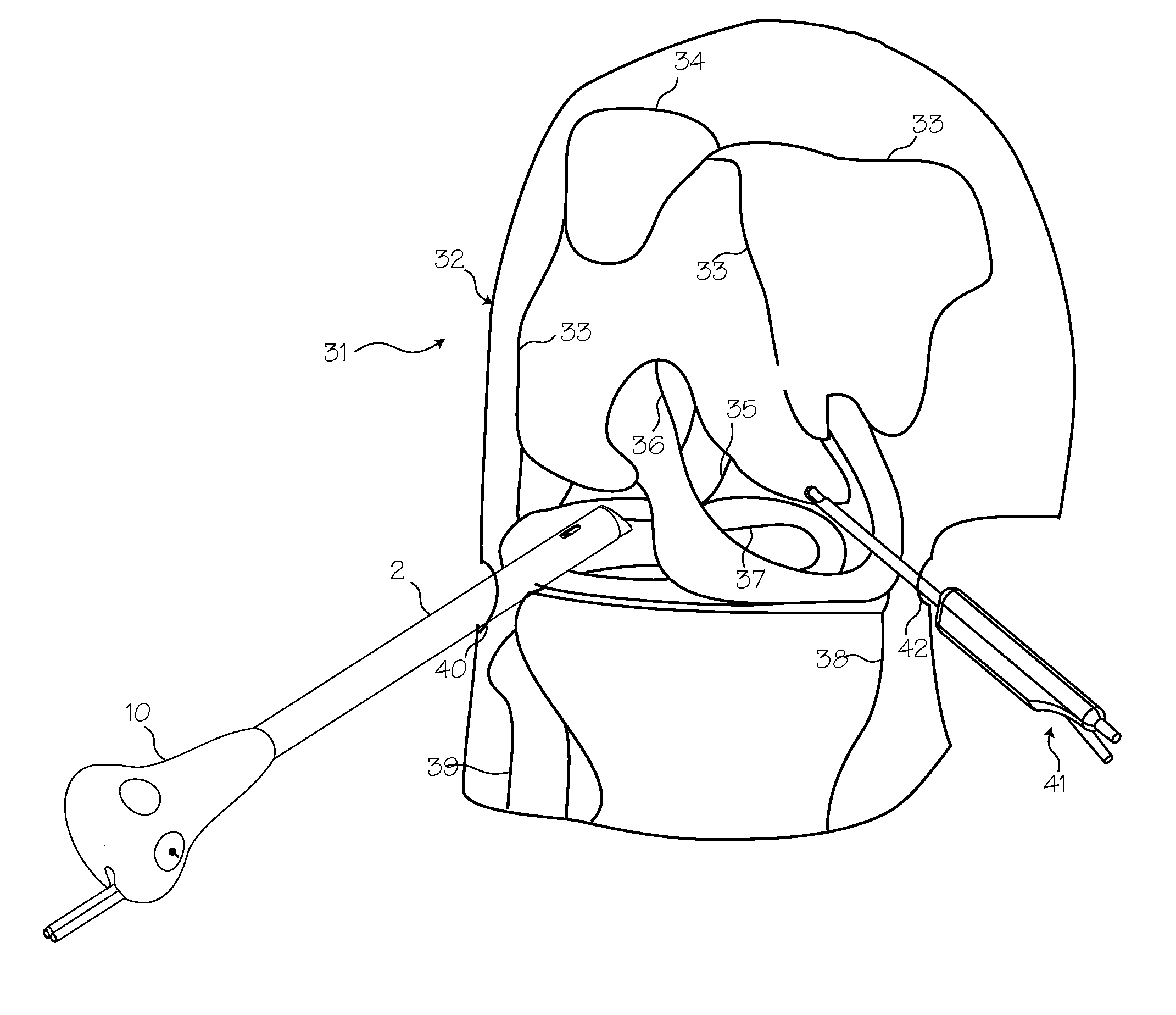 Arthroscopic System