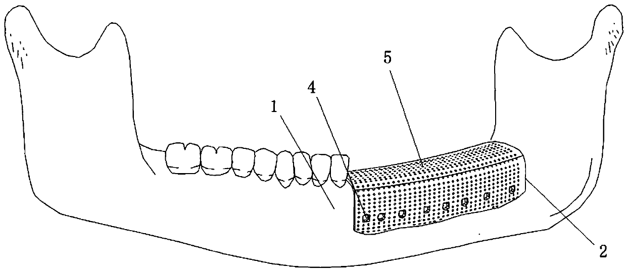 Titanium mesh implant with personalized alveolar bone augmentation generated by three-dimensional printing technology