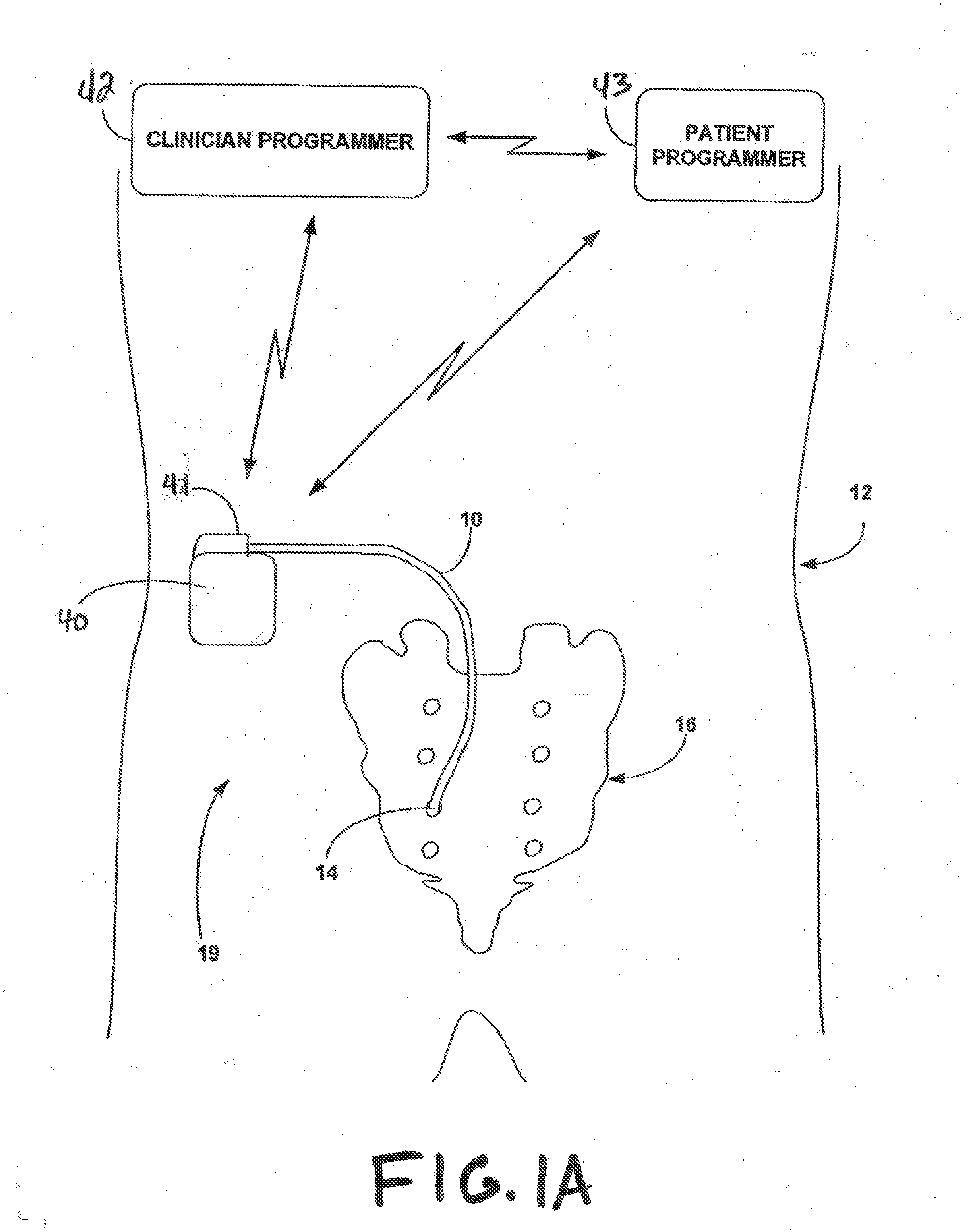 Implantable Medical Electrical Stimulation Lead Fixation Method and Apparatus