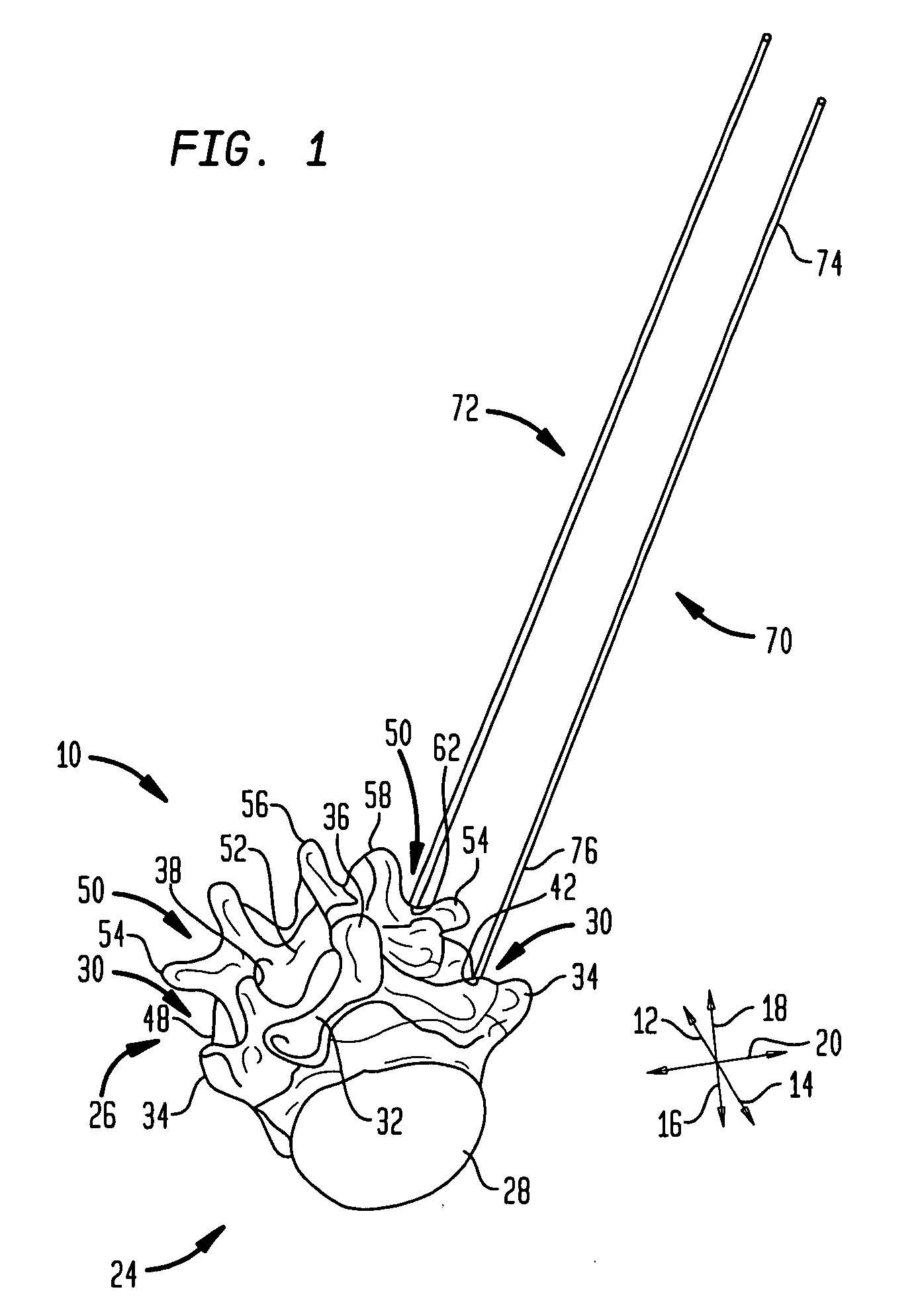 Rod contouring apparatus for percutaneous pedicle screw extension