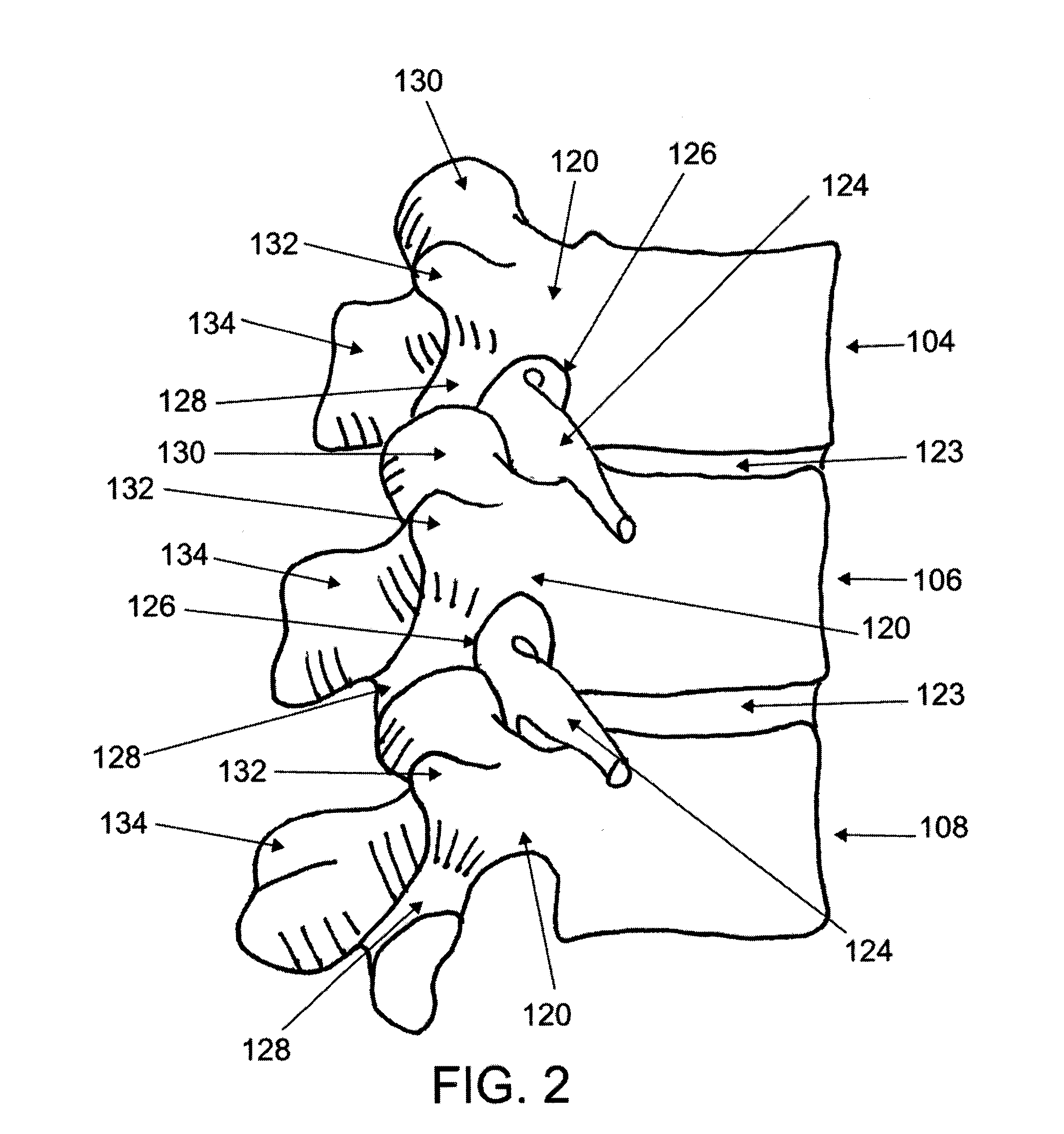 Articulating tissue removal systems and methods