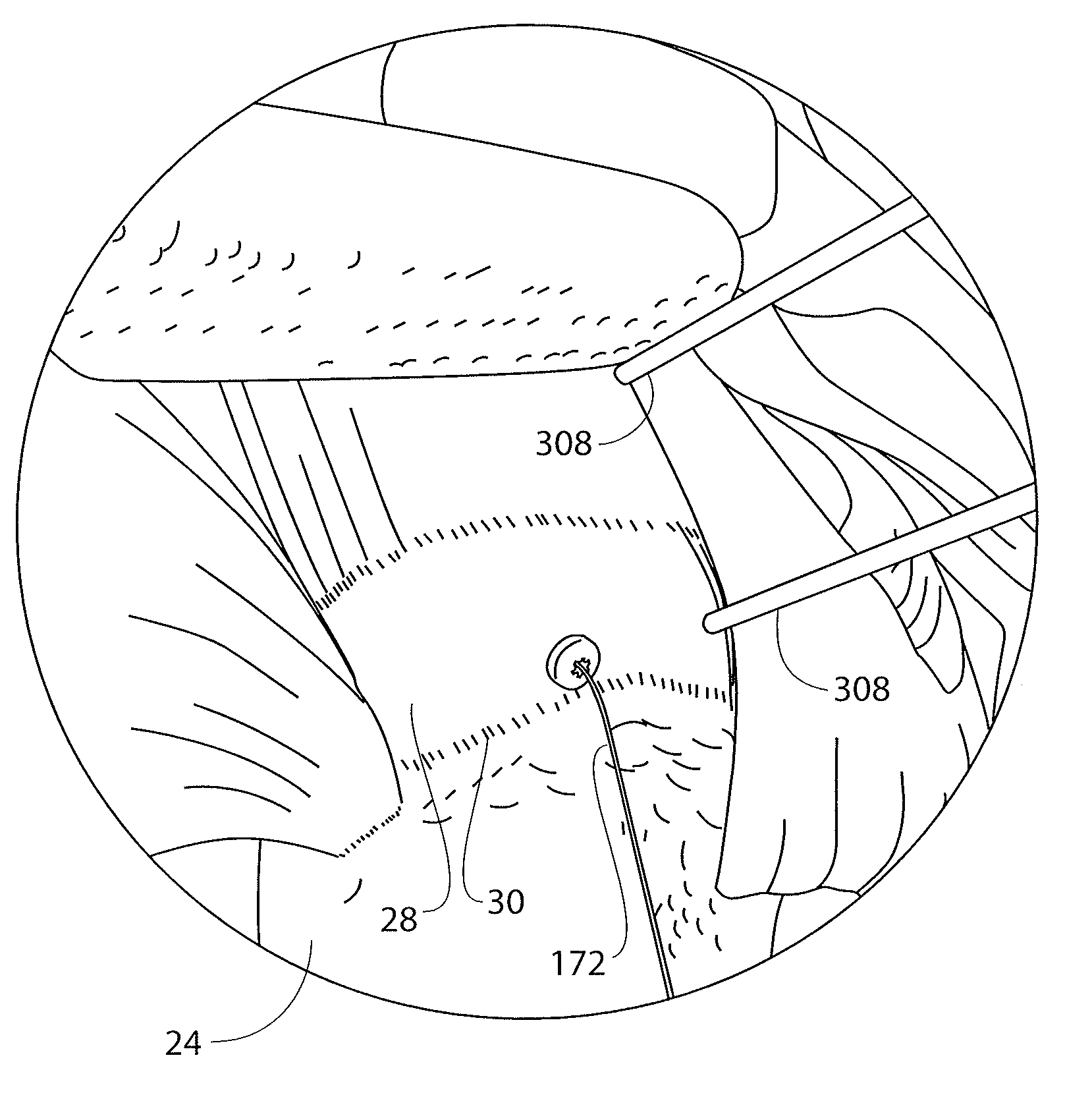 Guidewire having a distal fixation member for delivering and positioning sheet-like materials in surgery