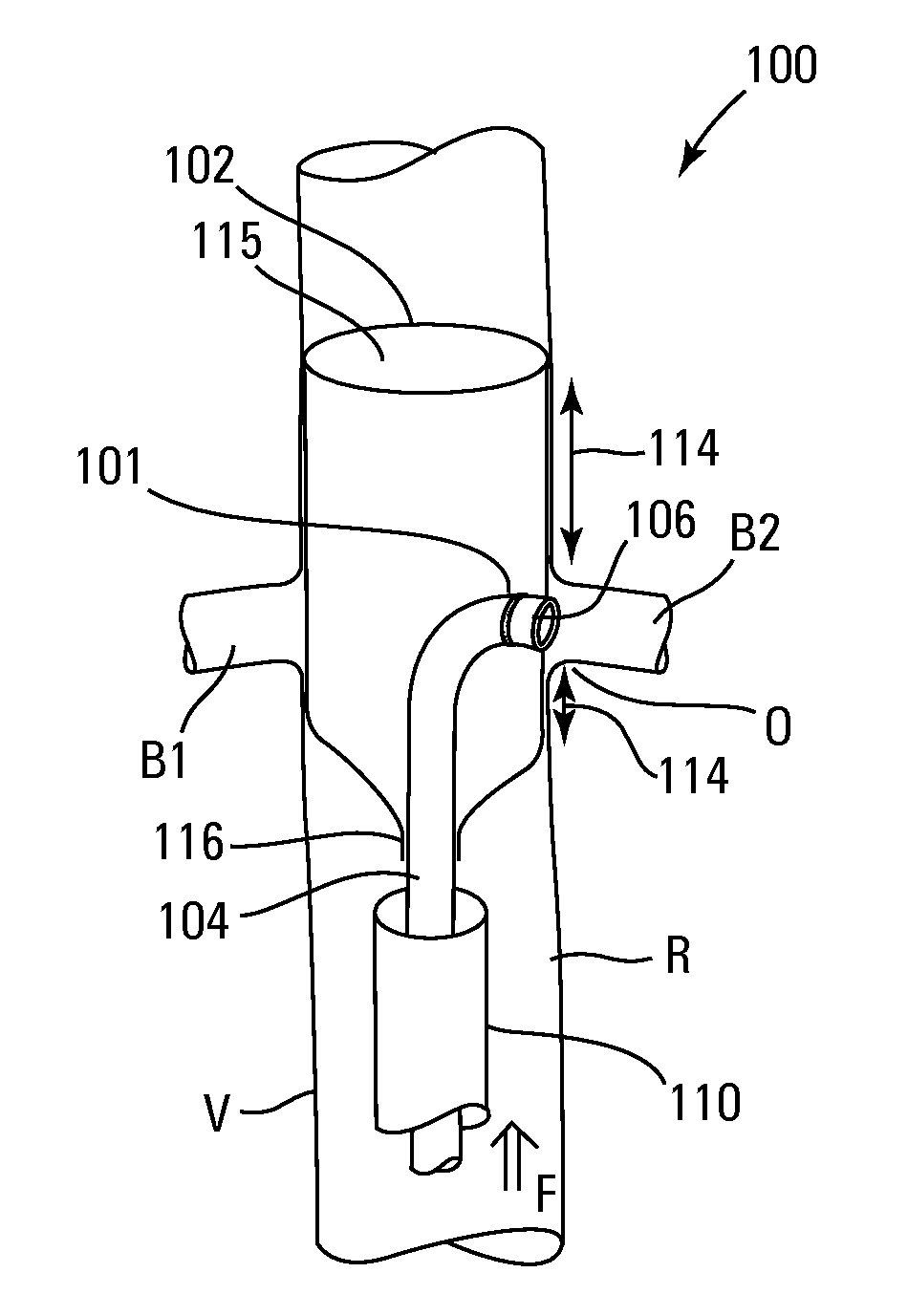 Embolic protection systems