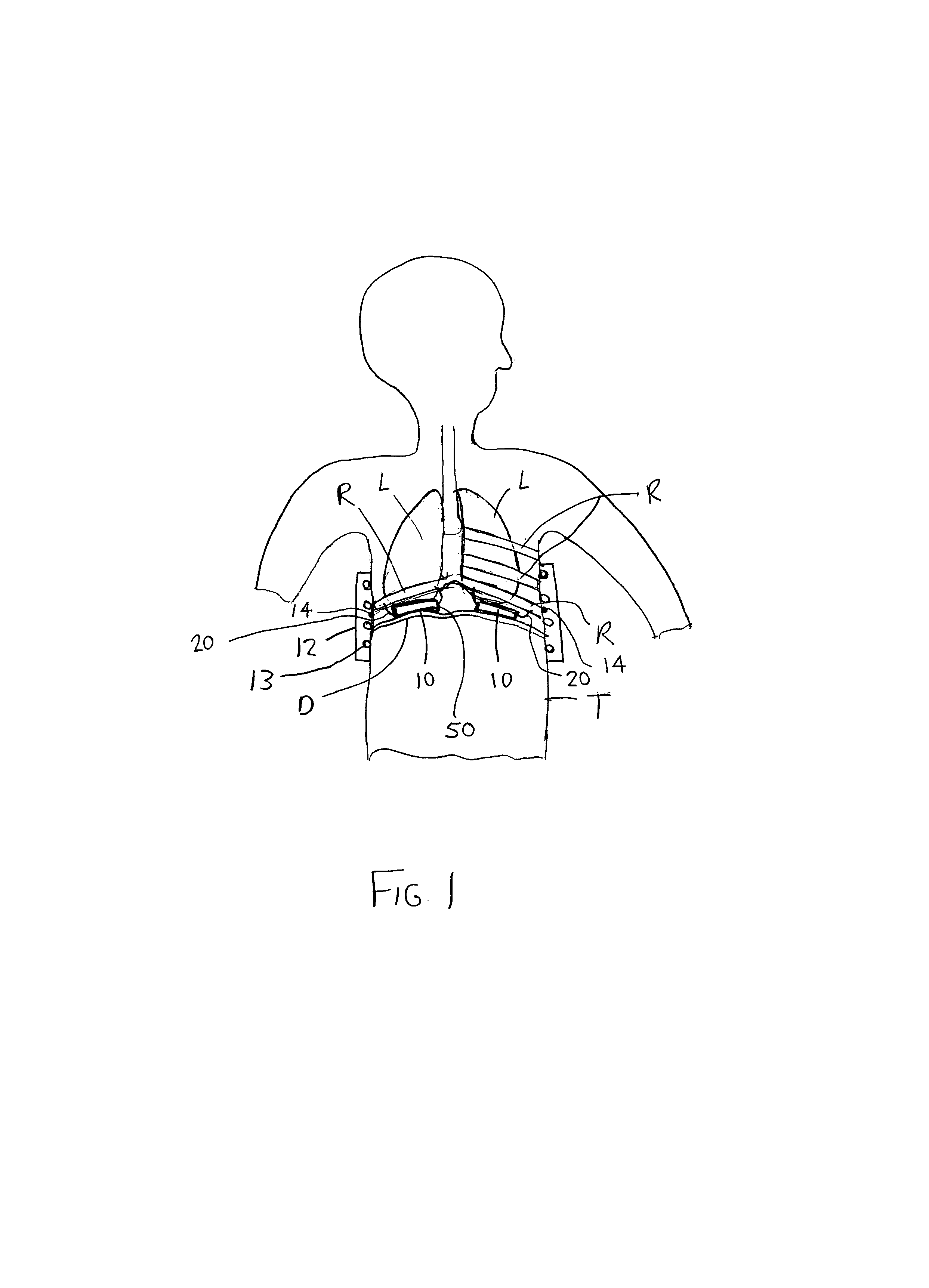 Electromagnetic diaphragm assist device and method for assisting a diaphragm function