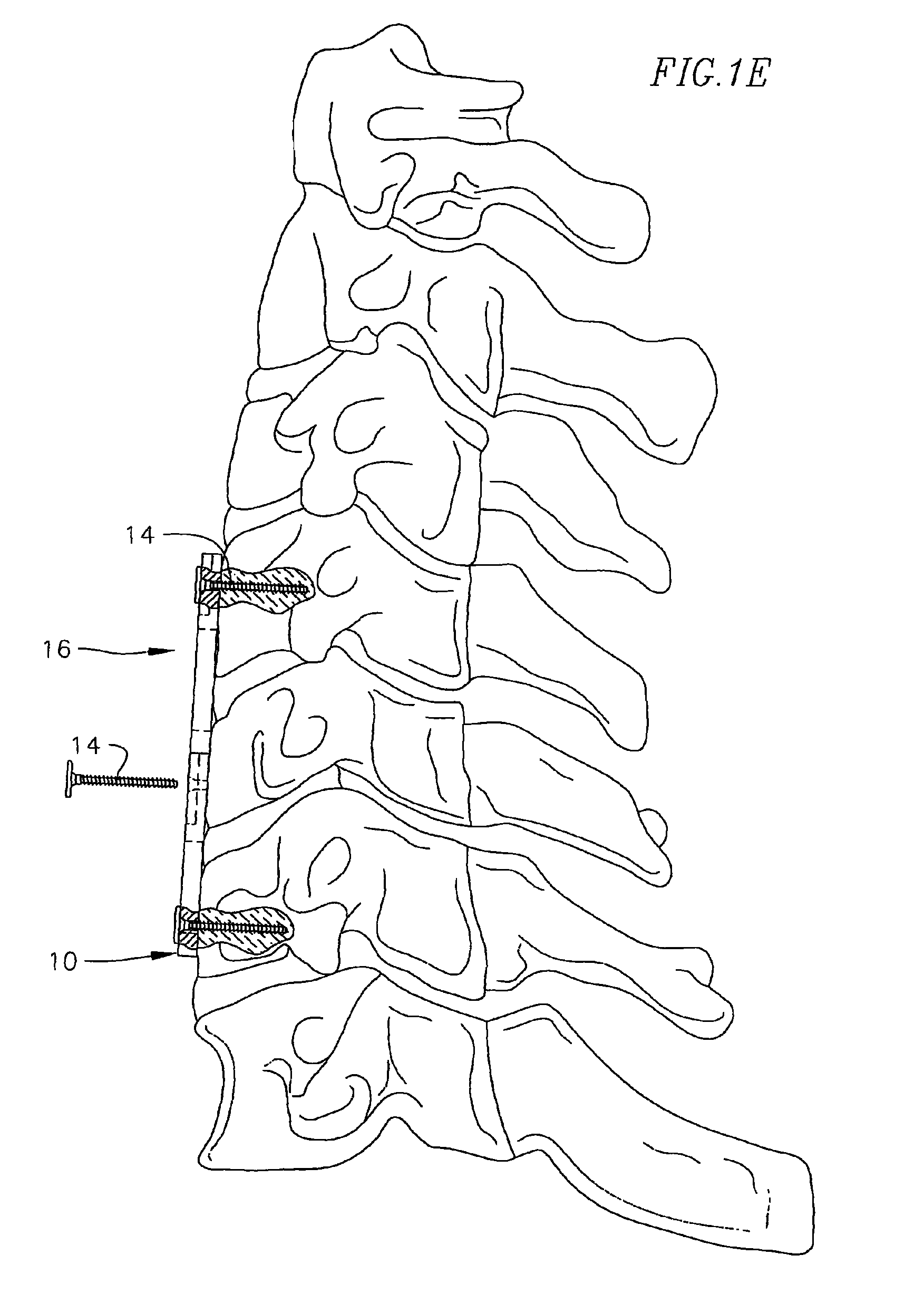 Revisable anterior cervical plating system