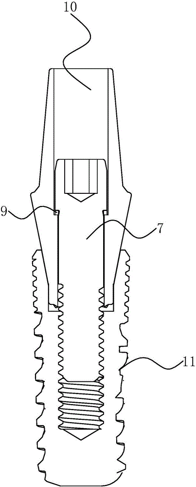 Implant tooth with high biocompatibility and stability