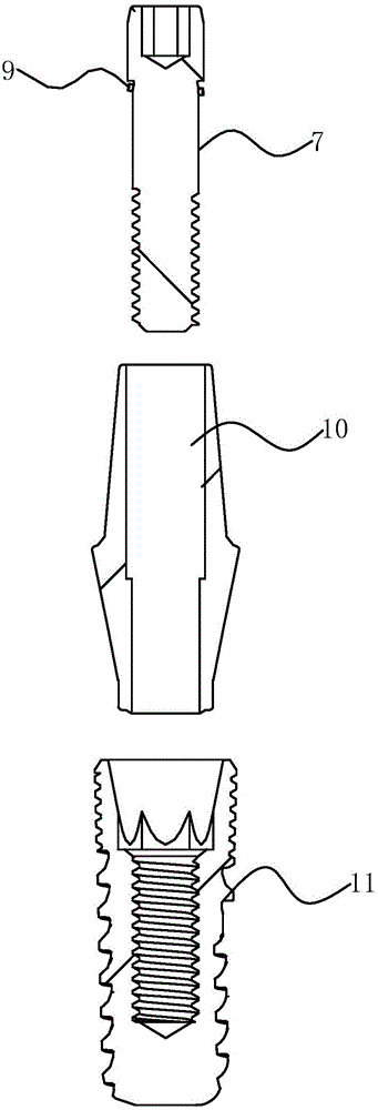 Implant tooth with high biocompatibility and stability