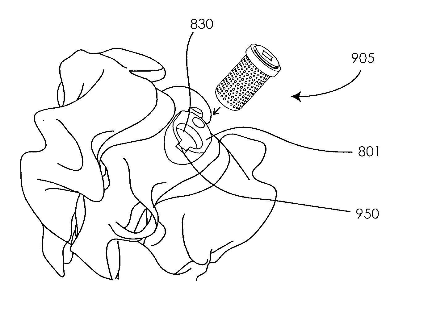 Transcorporeal spinal decompression and repair systems and related methods